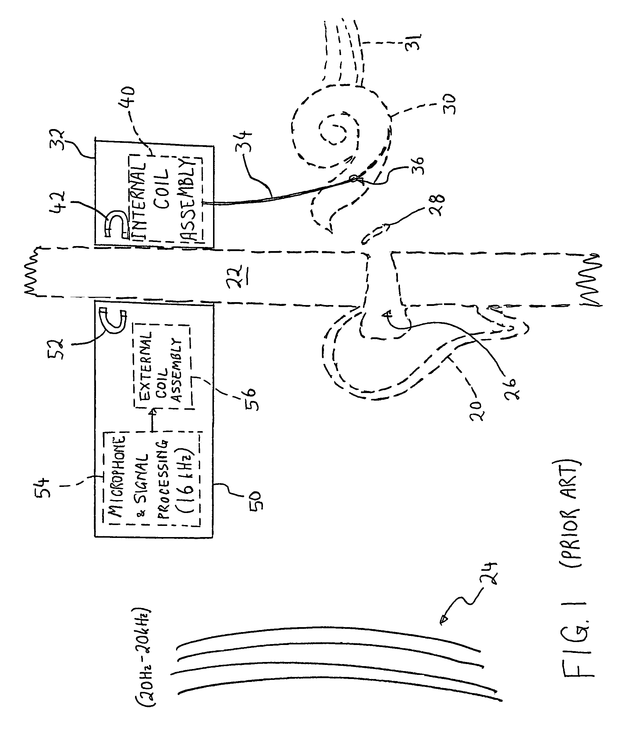 Cochlear implants with a stimulus in the human ultrasonic range and method for stimulating a cochlea