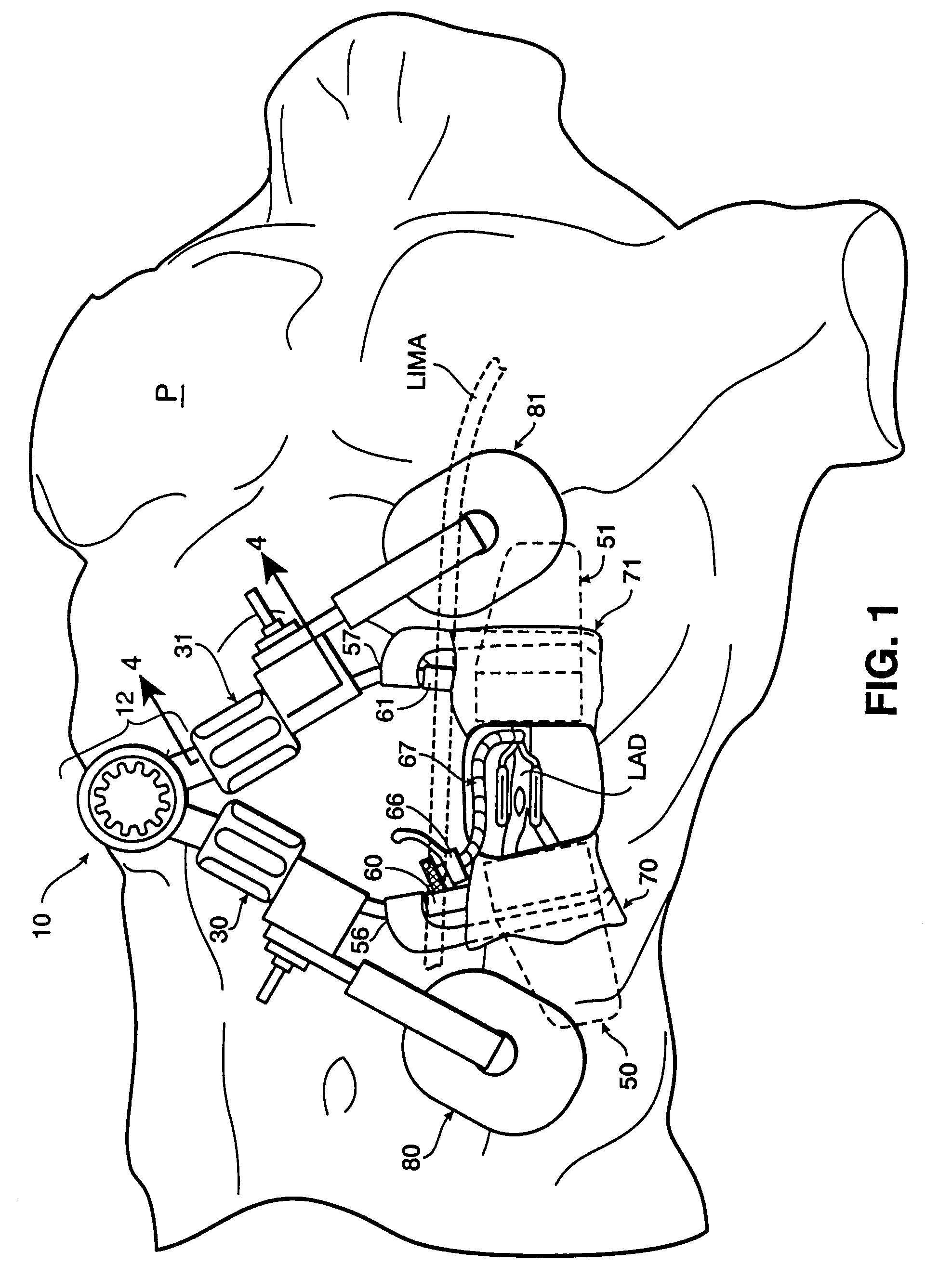 Access platform for internal mammary dissection