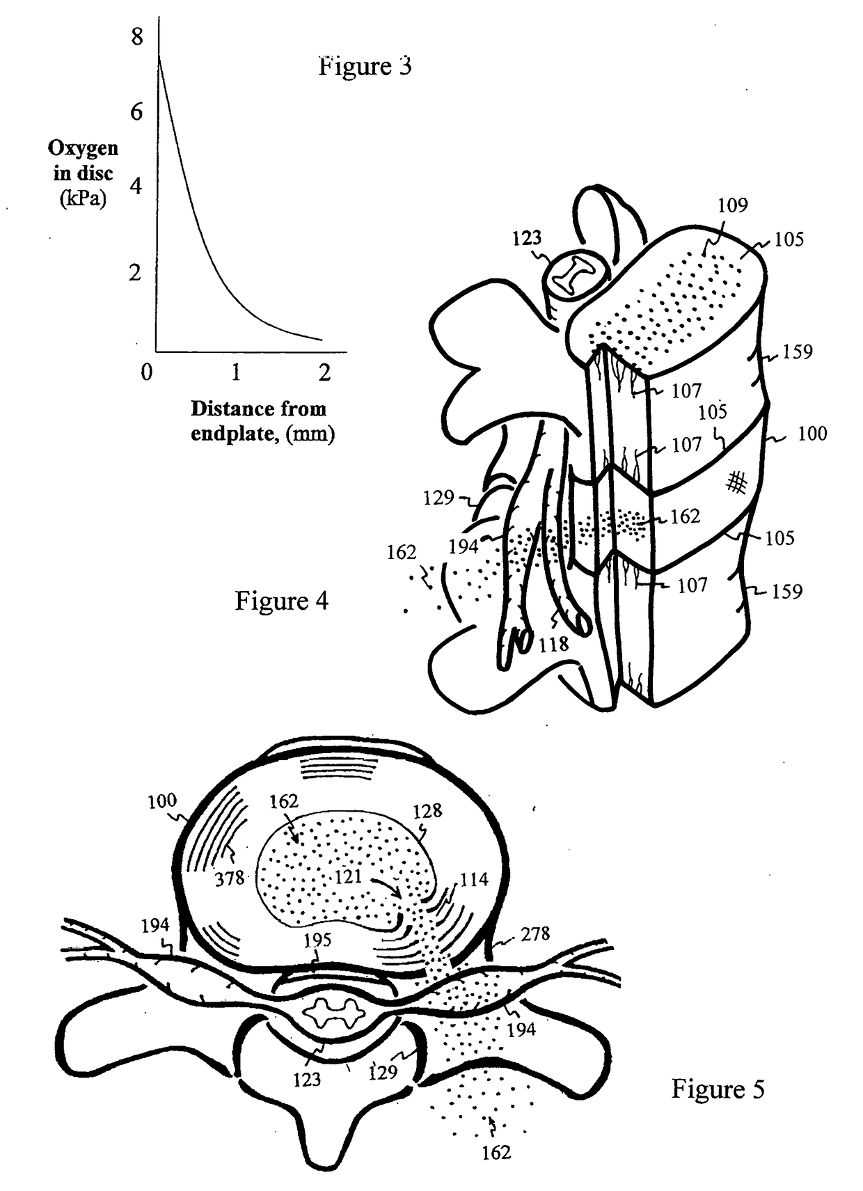 Method for relieving pain and regenerating intervertebral disc