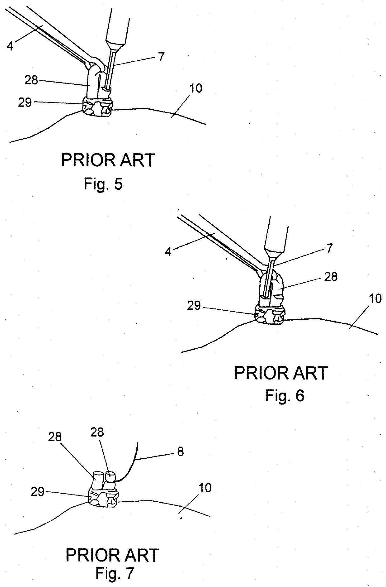 Vasectomy devices and methods for their use