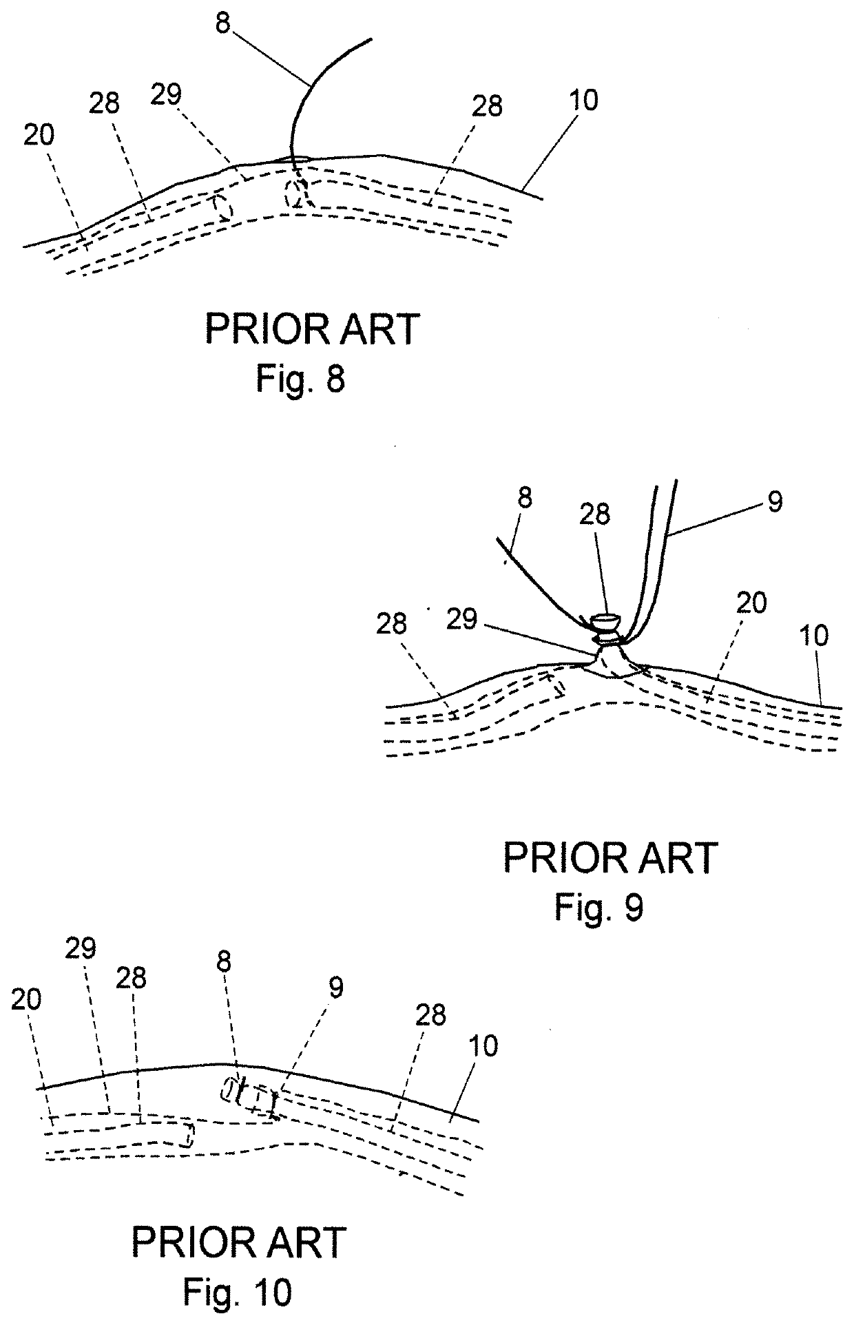 Vasectomy devices and methods for their use