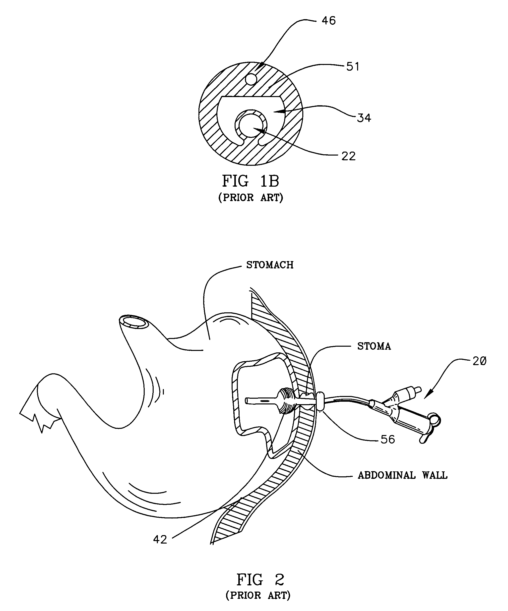 Retention device for medical components