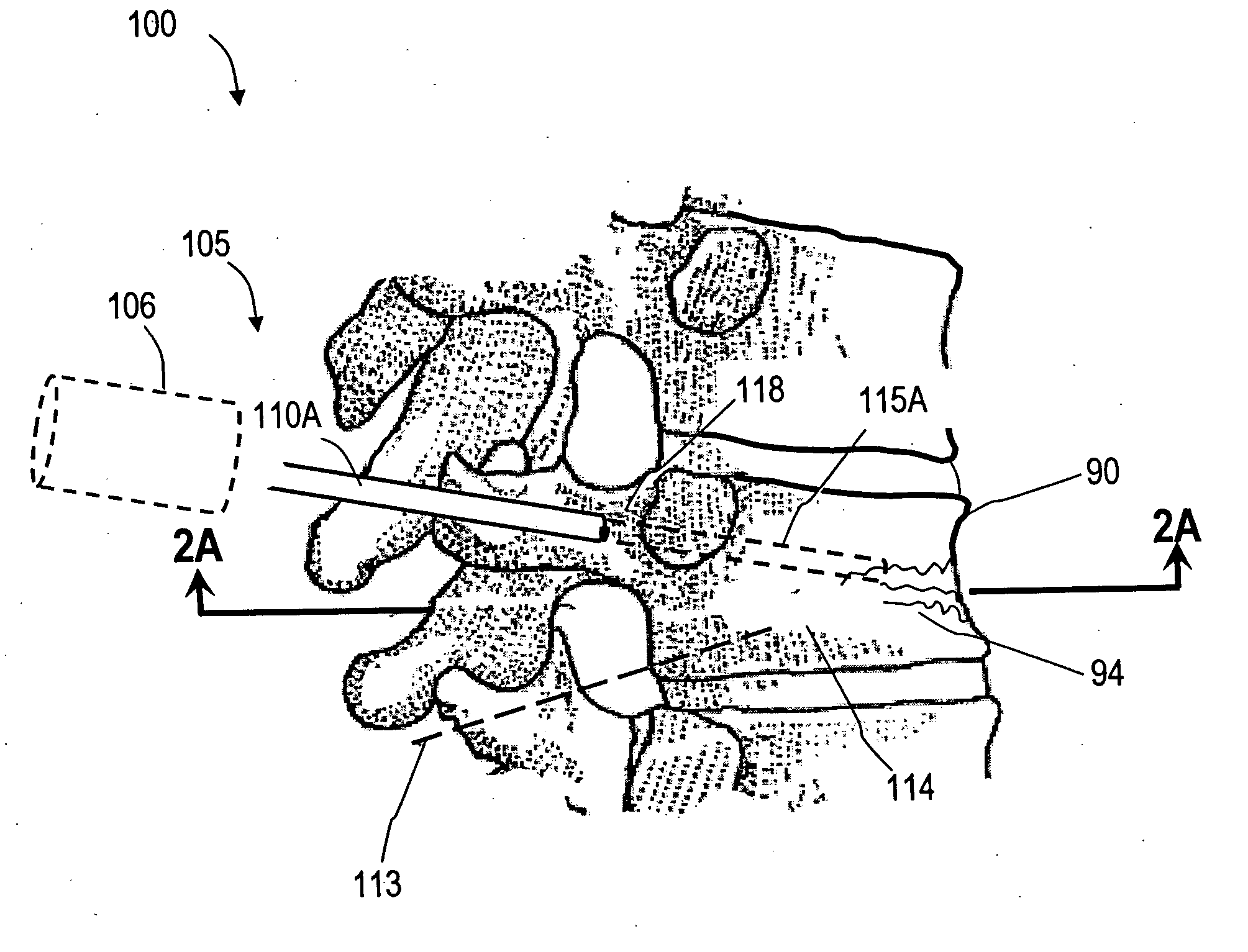 Bone treatment systems and methods