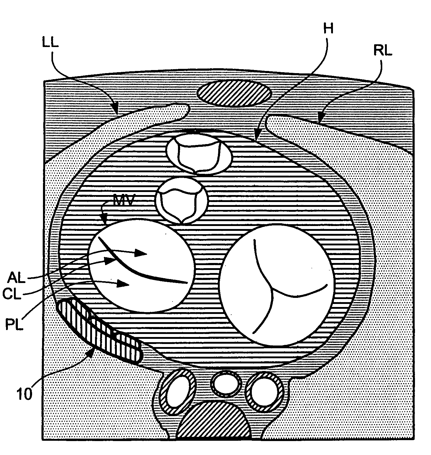 Decives and methods for heart valve treatment
