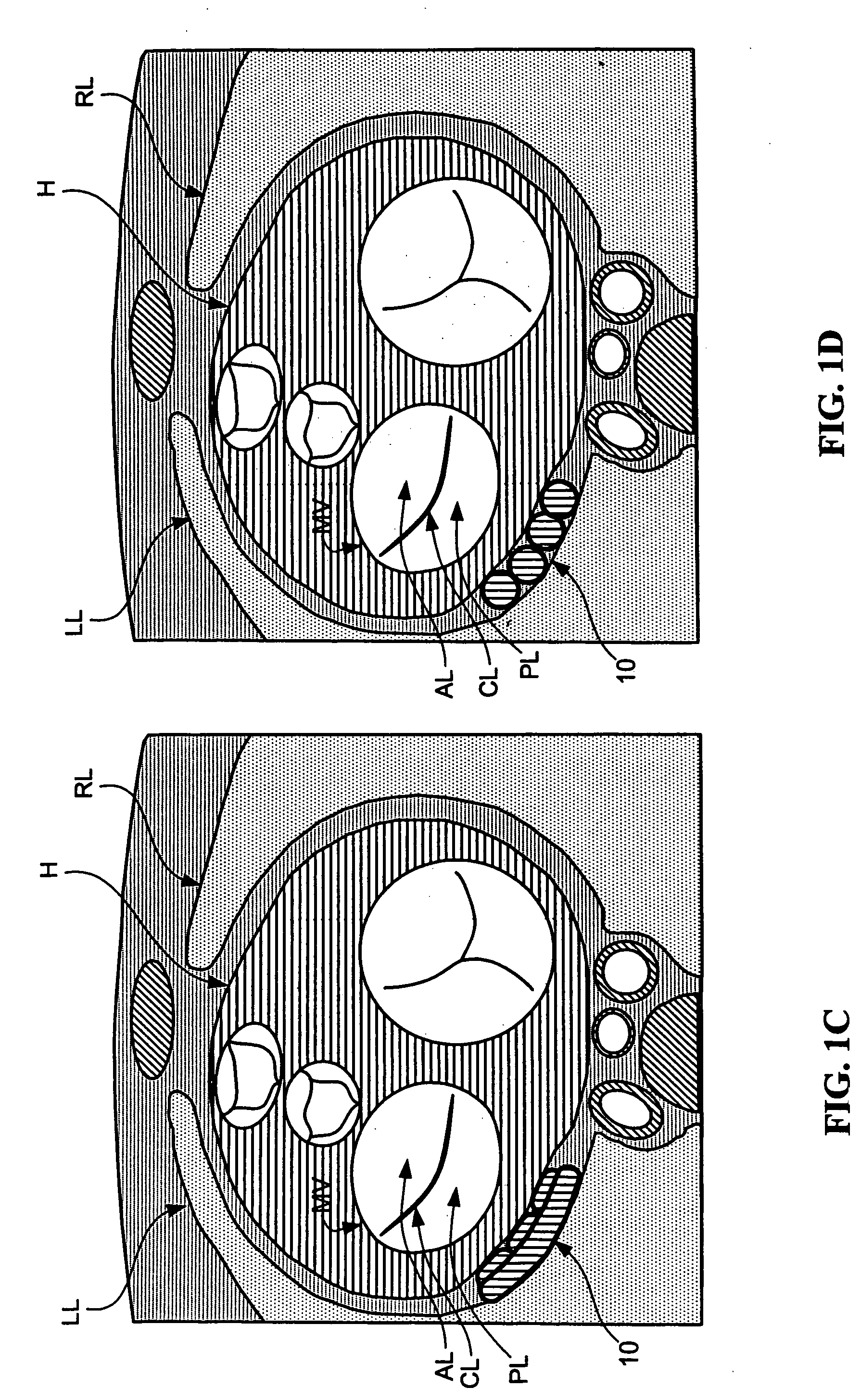 Decives and methods for heart valve treatment