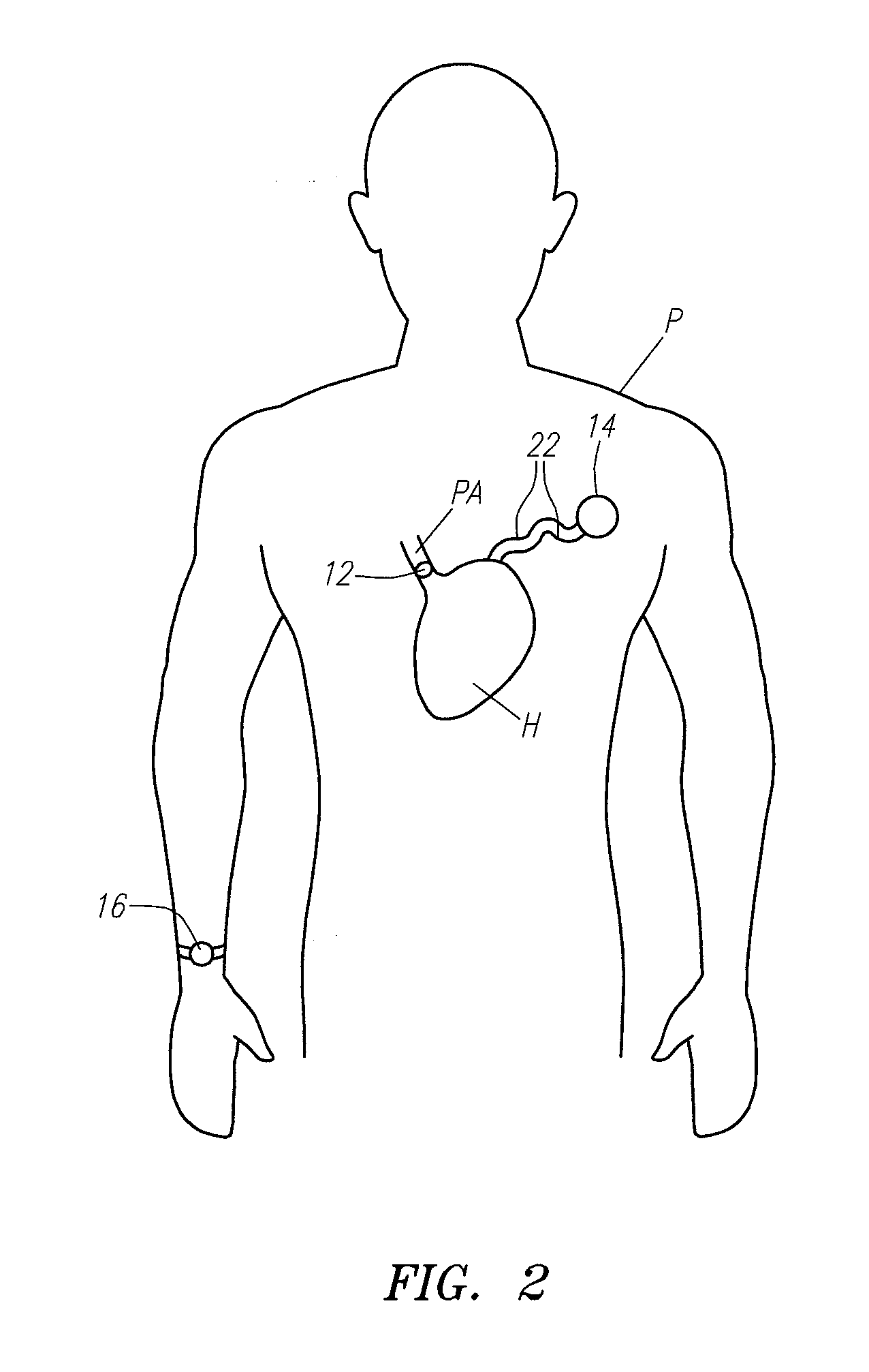 Body attachable unit in wireless communication with implantable devices