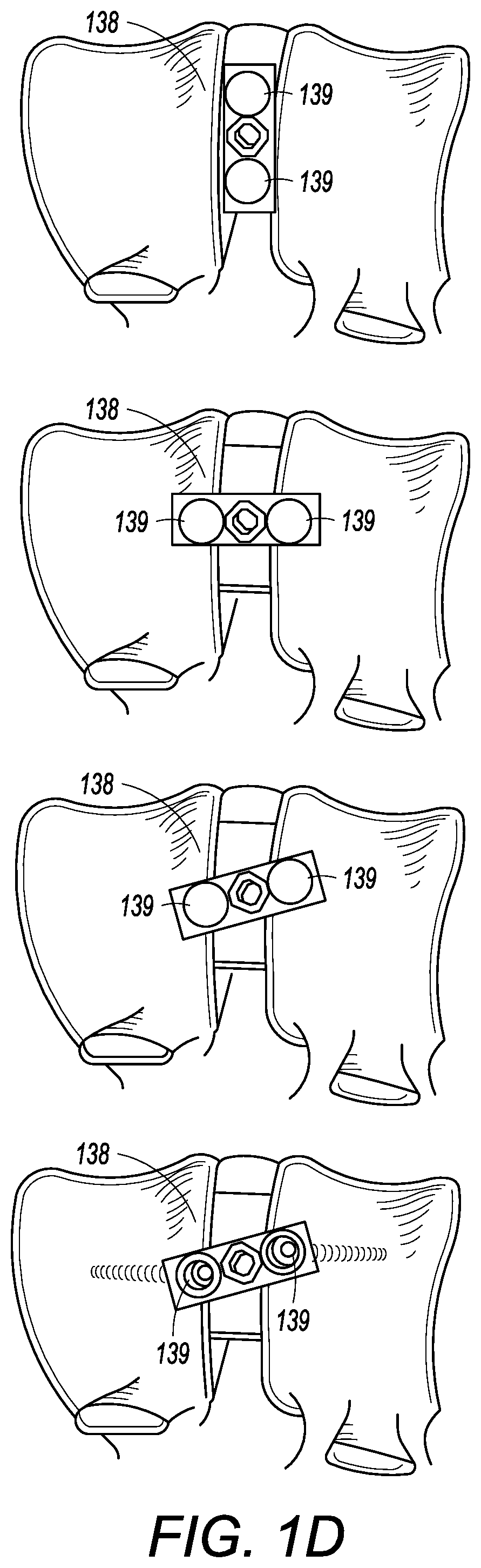 Interbody cage with spill-free biological material compartment