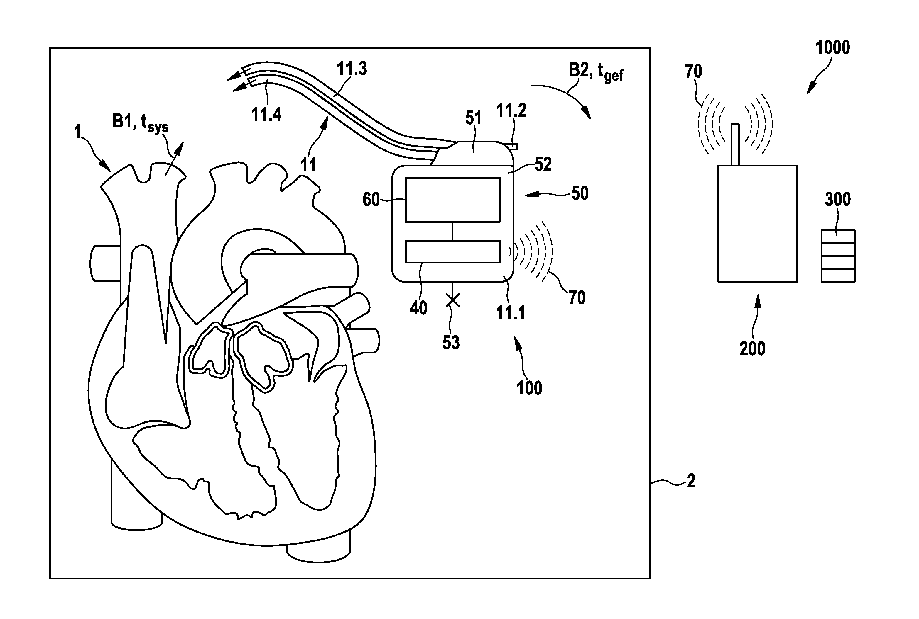 Electromedical implant and monitoring system including the electromedical implant