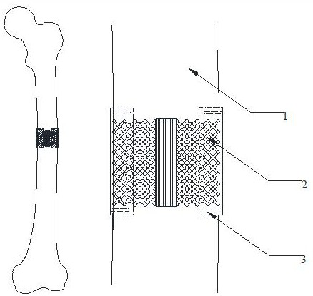 Preparation method of femoral middle-end regenerative bone scaffold with porous functional gradient structure