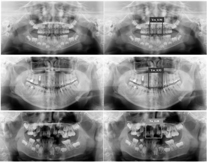 Single-step deep network-based automatic detection method for median multiple raw teeth in curved surface body layer graph