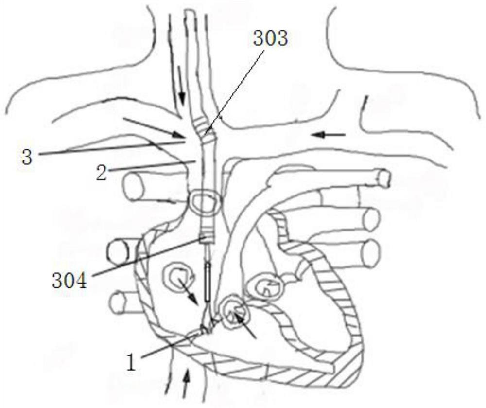 A universal heart valve interventional angioplasty system