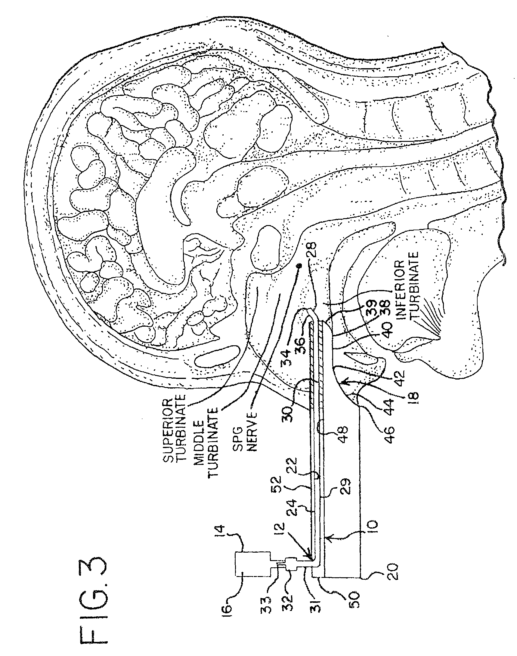 Methods for Ameliorating Pain and Devices for Delivering a Medicament