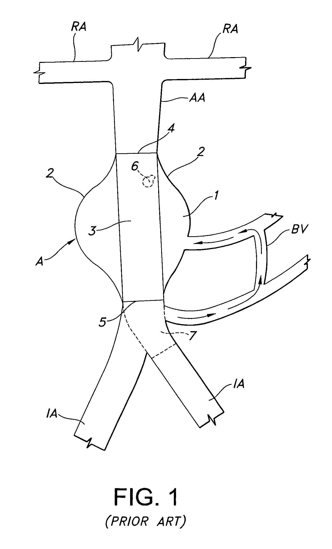 Implantable prosthesis with displaceable skirt