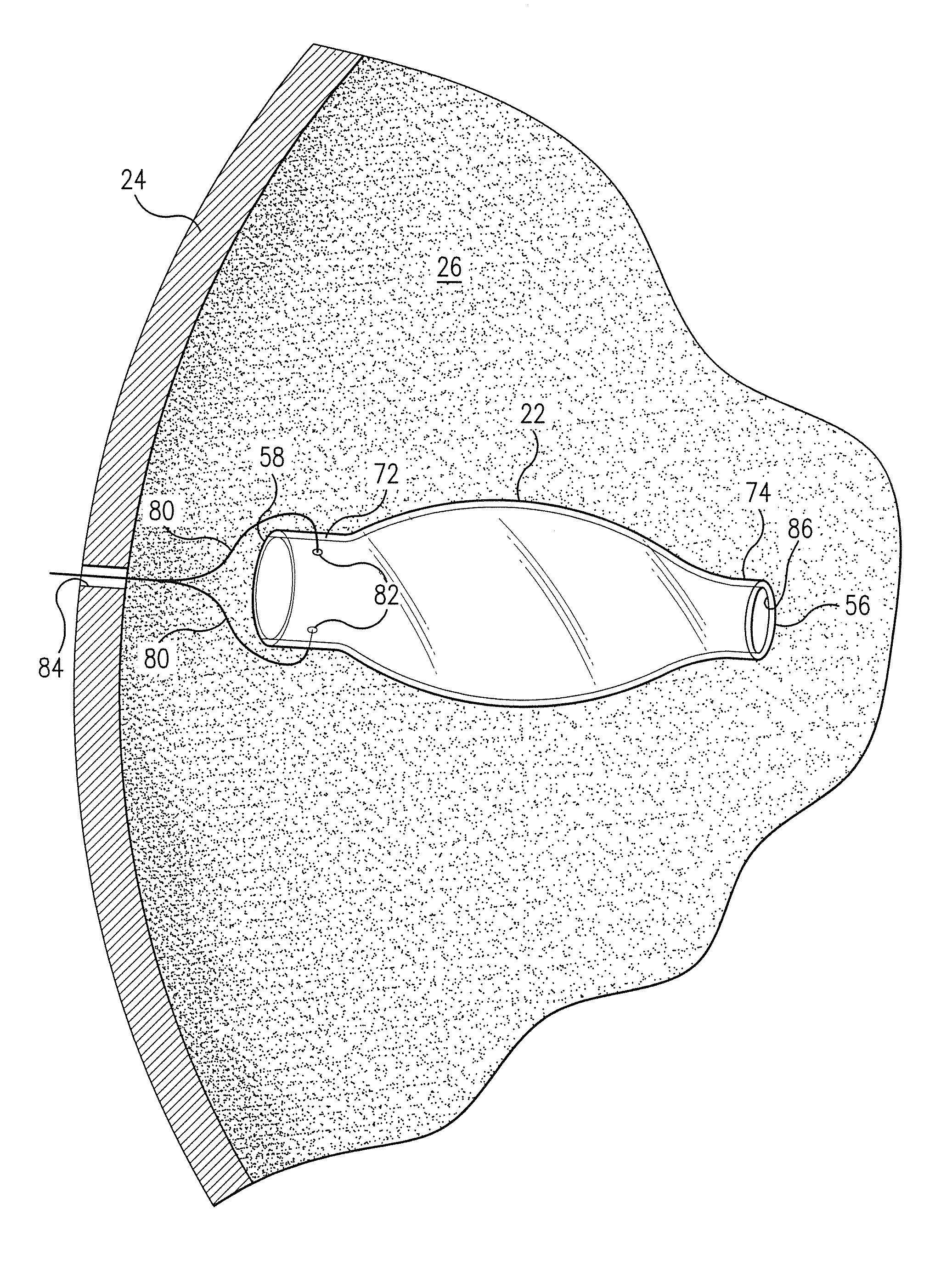 Bioresorbable drug eluting intravitreal implant system and method