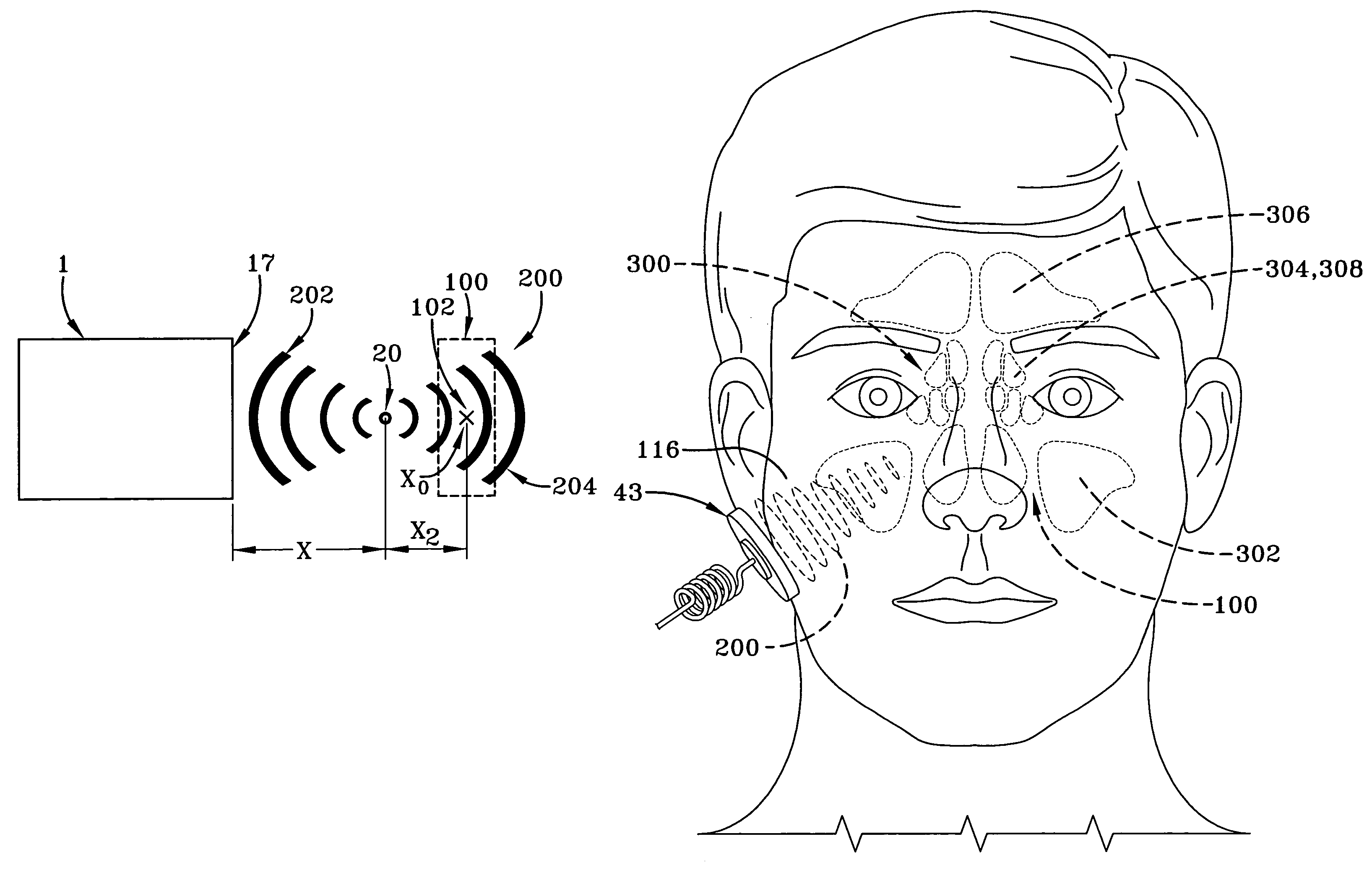 Germicidal method for treating or preventing sinusitis