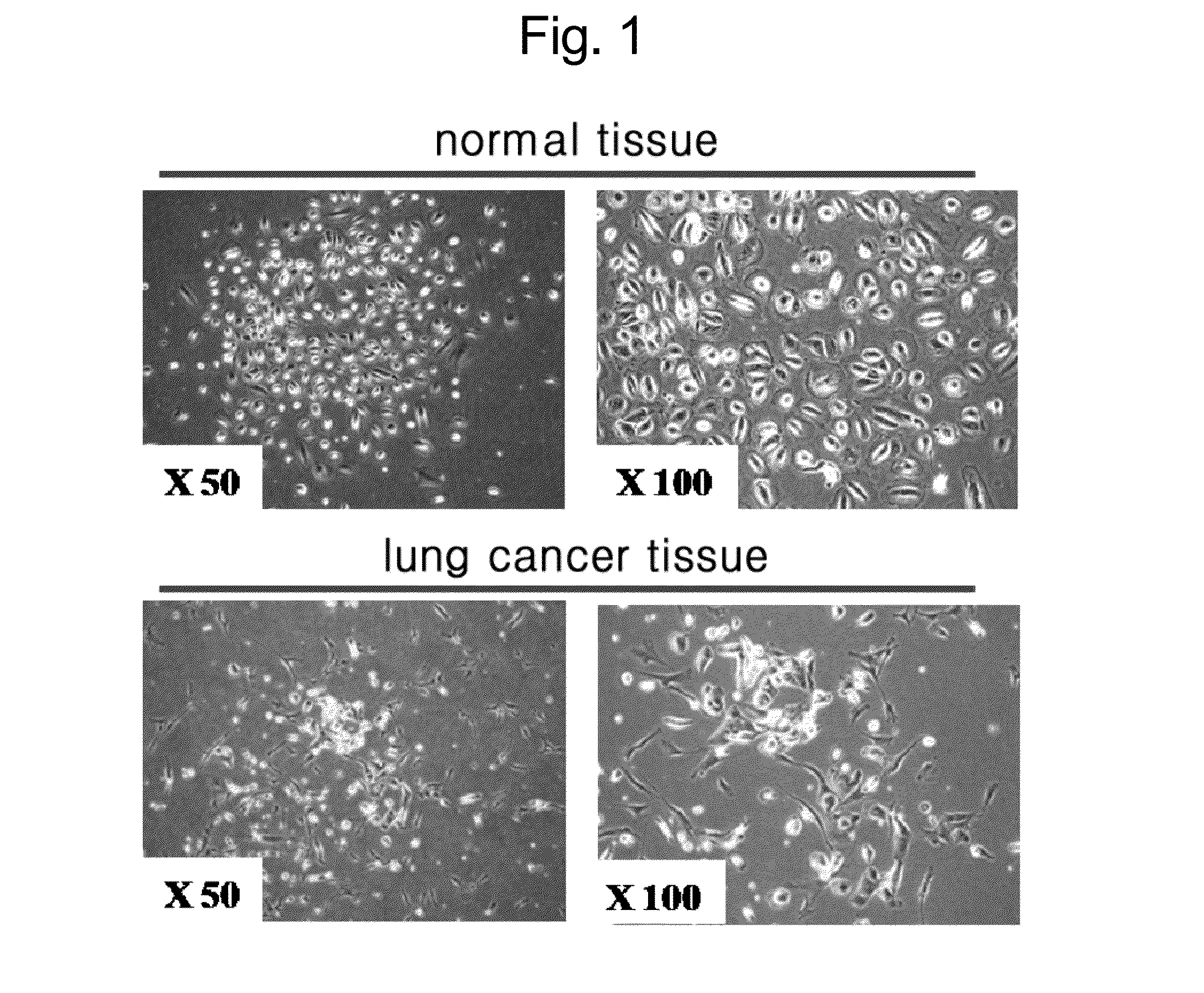 Composition for diagnosis of lung cancer and diagnosis kit of lung cancer