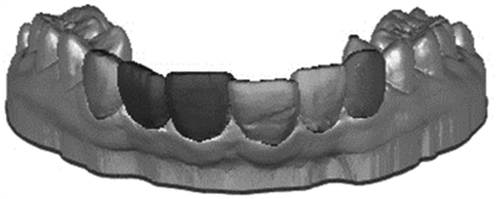 Automatic dental digital model segmentation algorithm