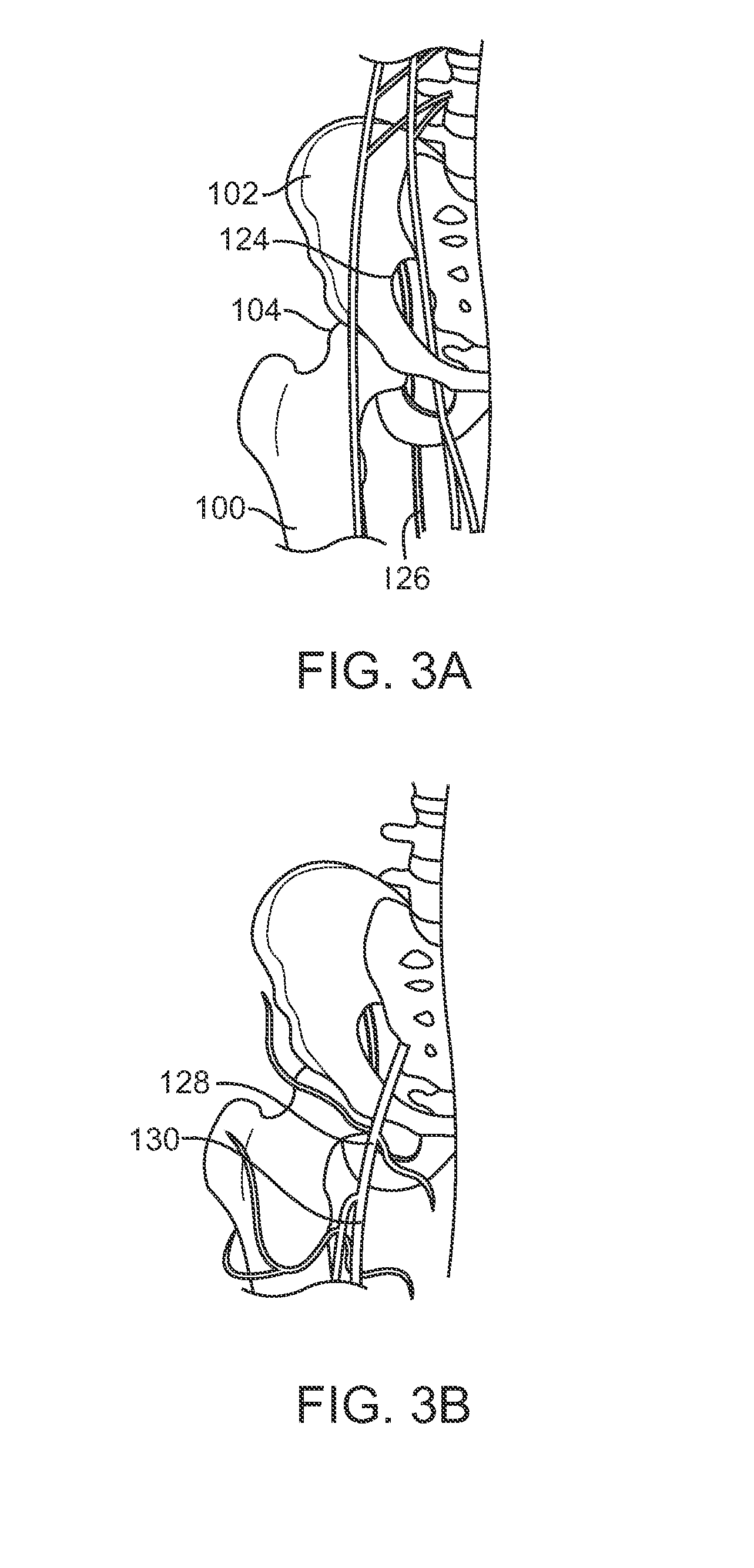 Apparatus for controlling a load on a hip joint