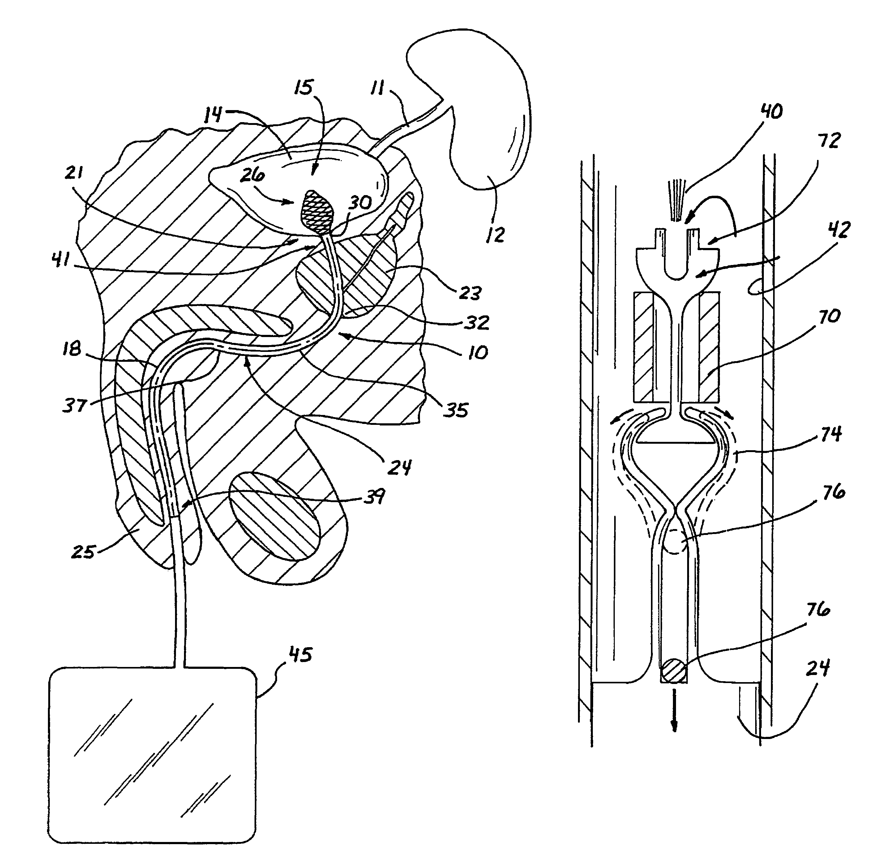 Drainage catheter having an expandable retention member