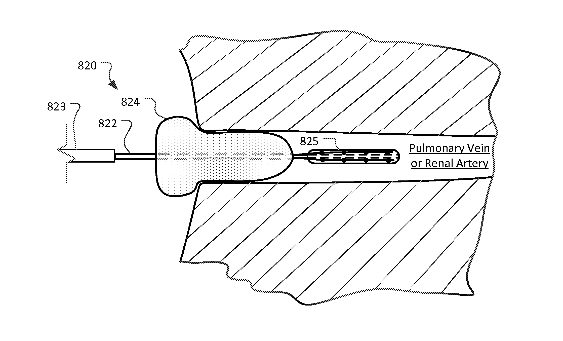 Devices and methods for ablation of tissue