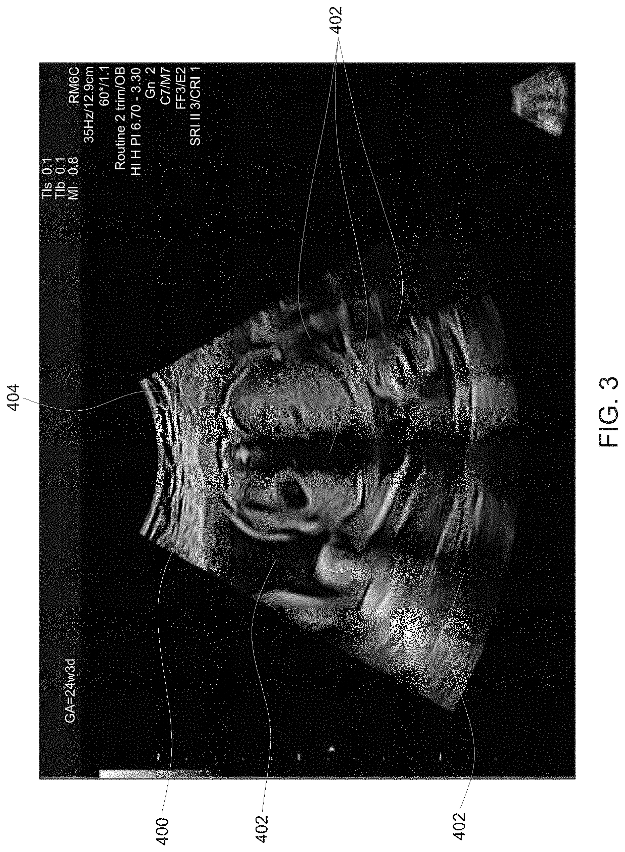 Ultrasound imaging system and method for generating an enhanced image