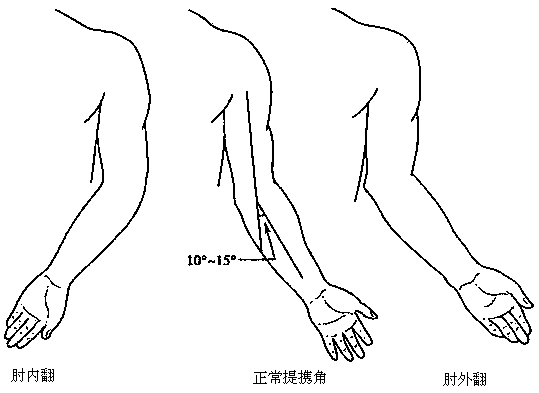 Device for correcting varus and valgus deformity of elbow joints
