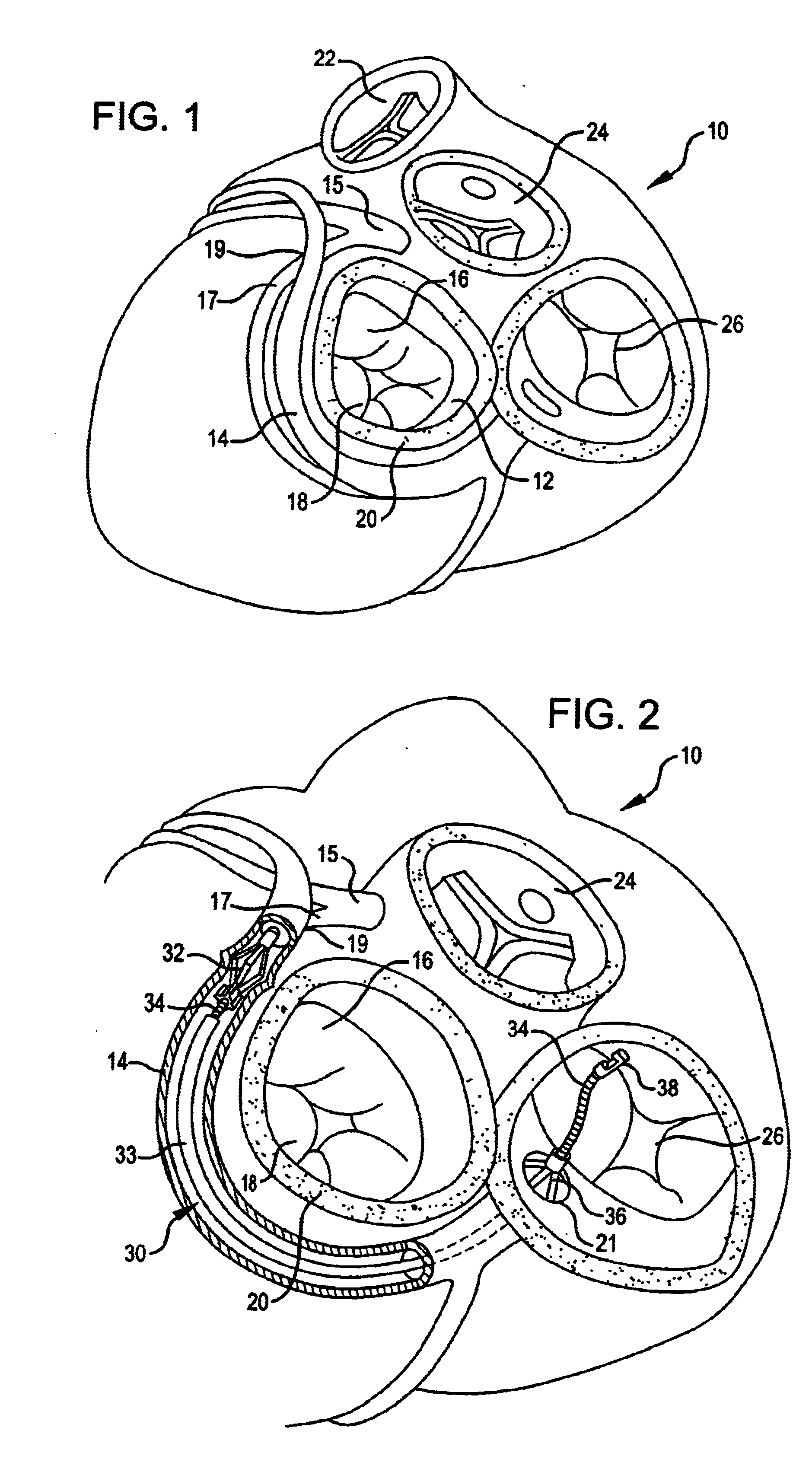 Anchor and pull mitral valve device and method