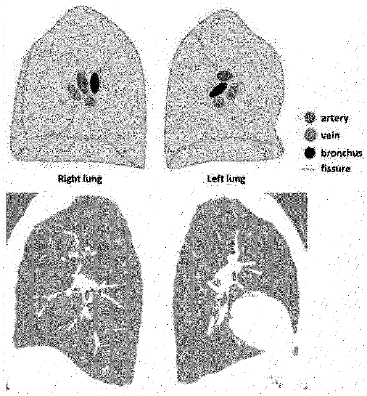 Method for distinguishing pulmonary artery and pulmonary vein, and method for quantifying blood vessels using same