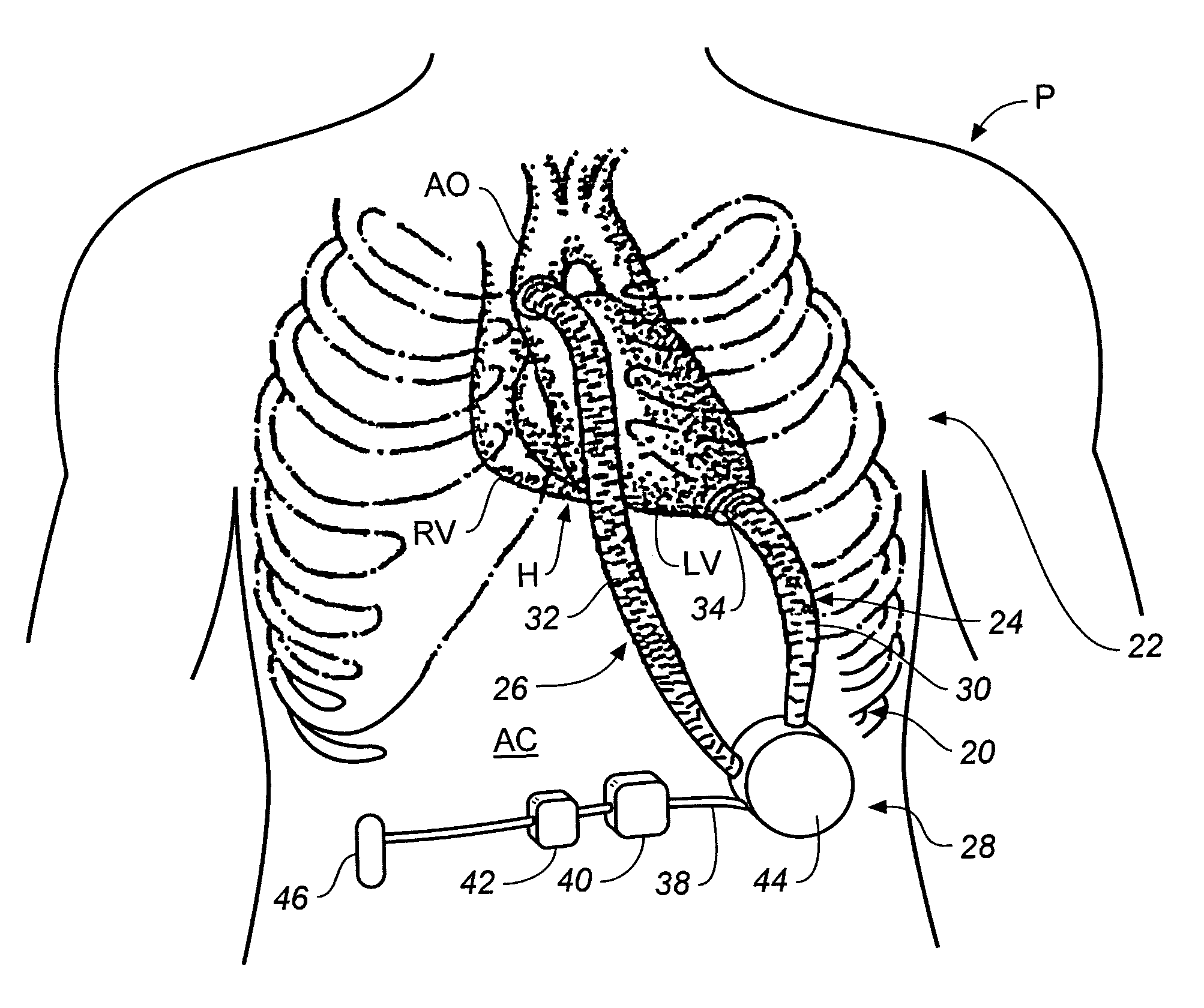 Miniature, pulsatile implantable ventricular assist devices and methods of controlling ventricular assist devices