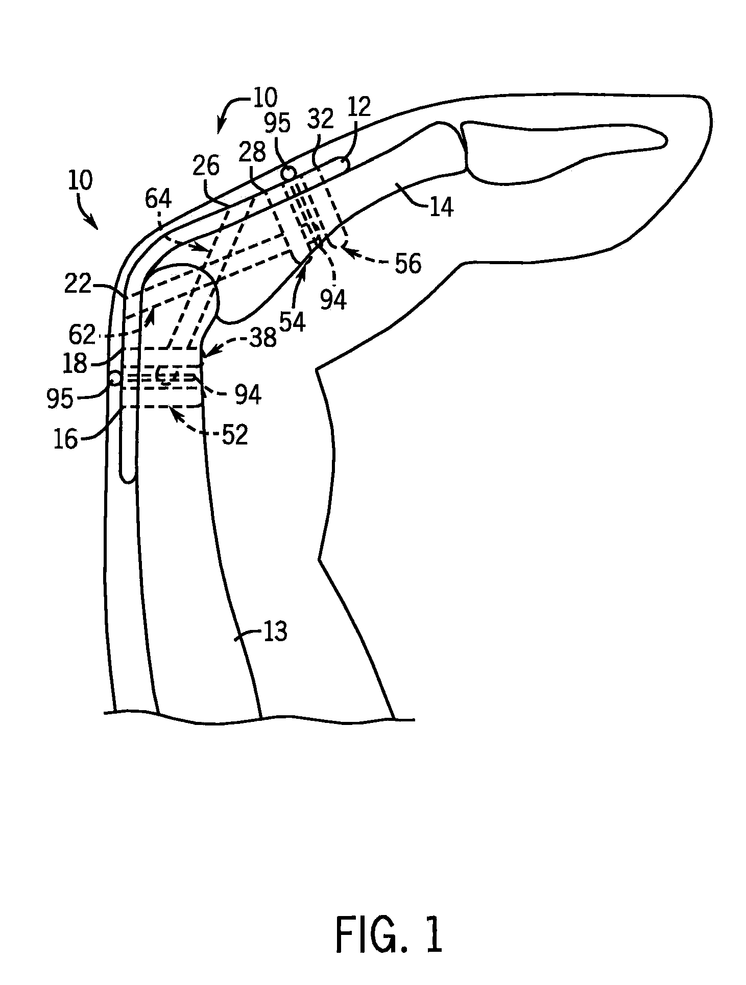 Joint Fixation System For the Hand