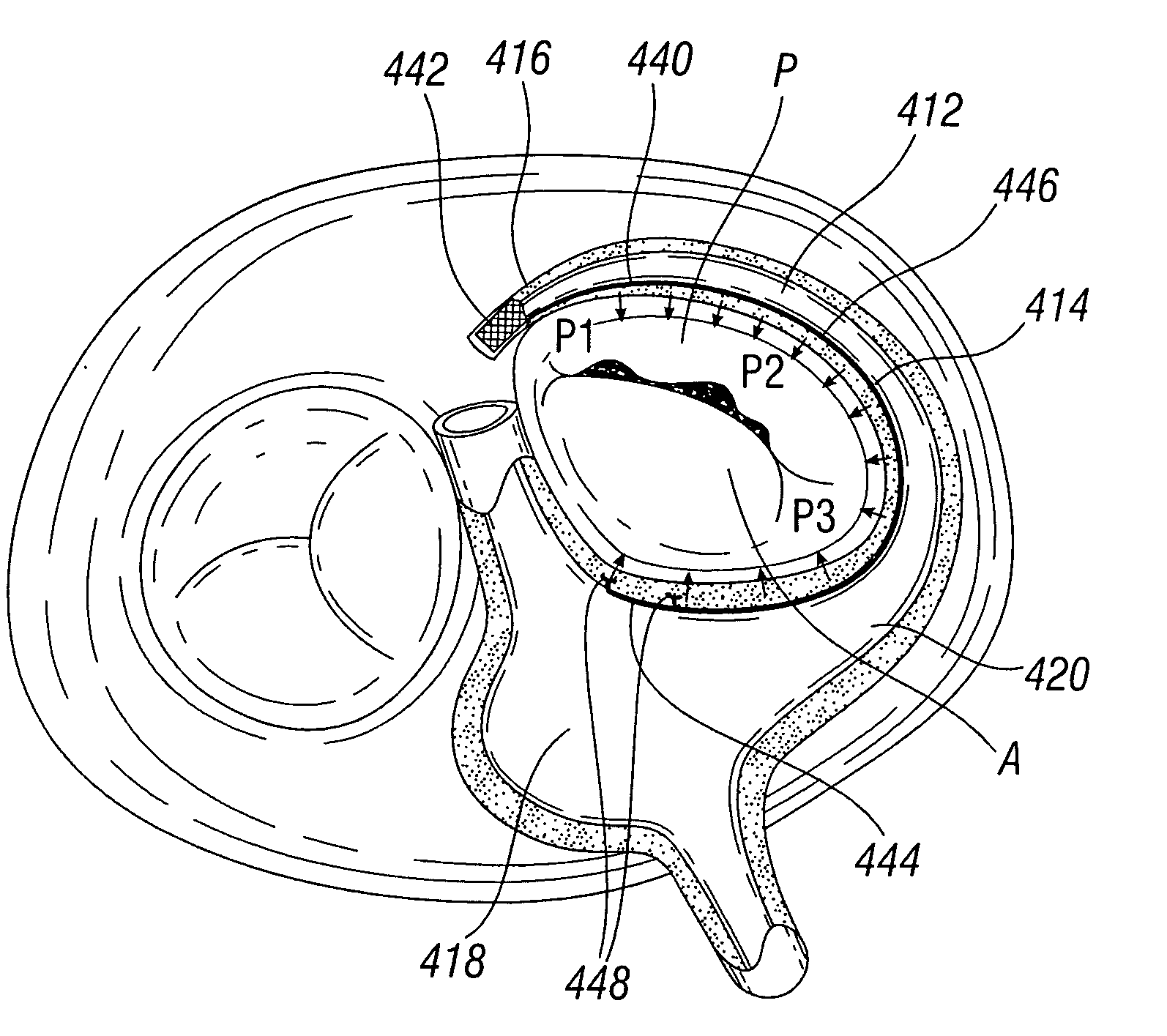 Device and method for mitral valve repair