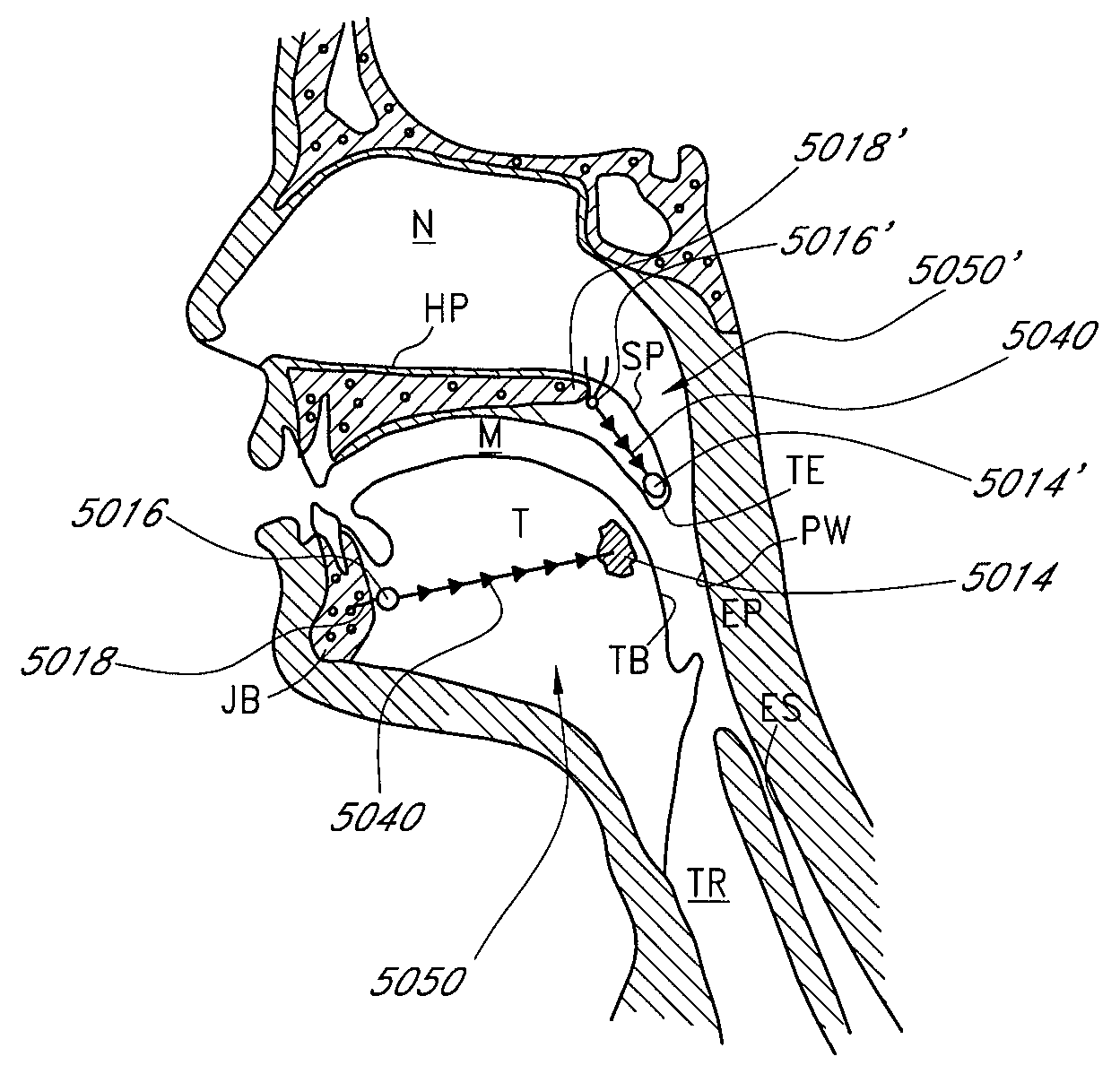 Airway implants and methods and devices for insertion and retrieval