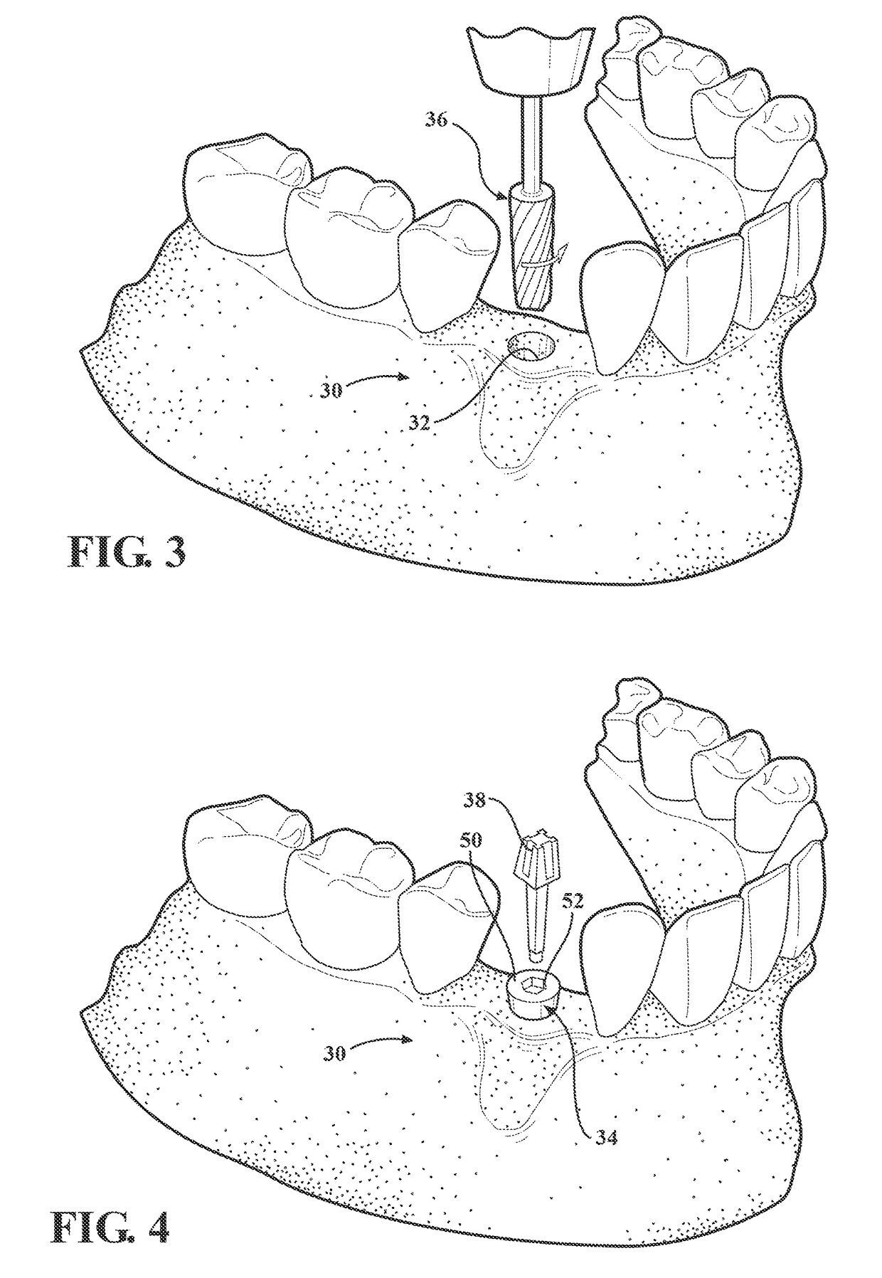 Implant/anchor for cellular and visco-elastic materials
