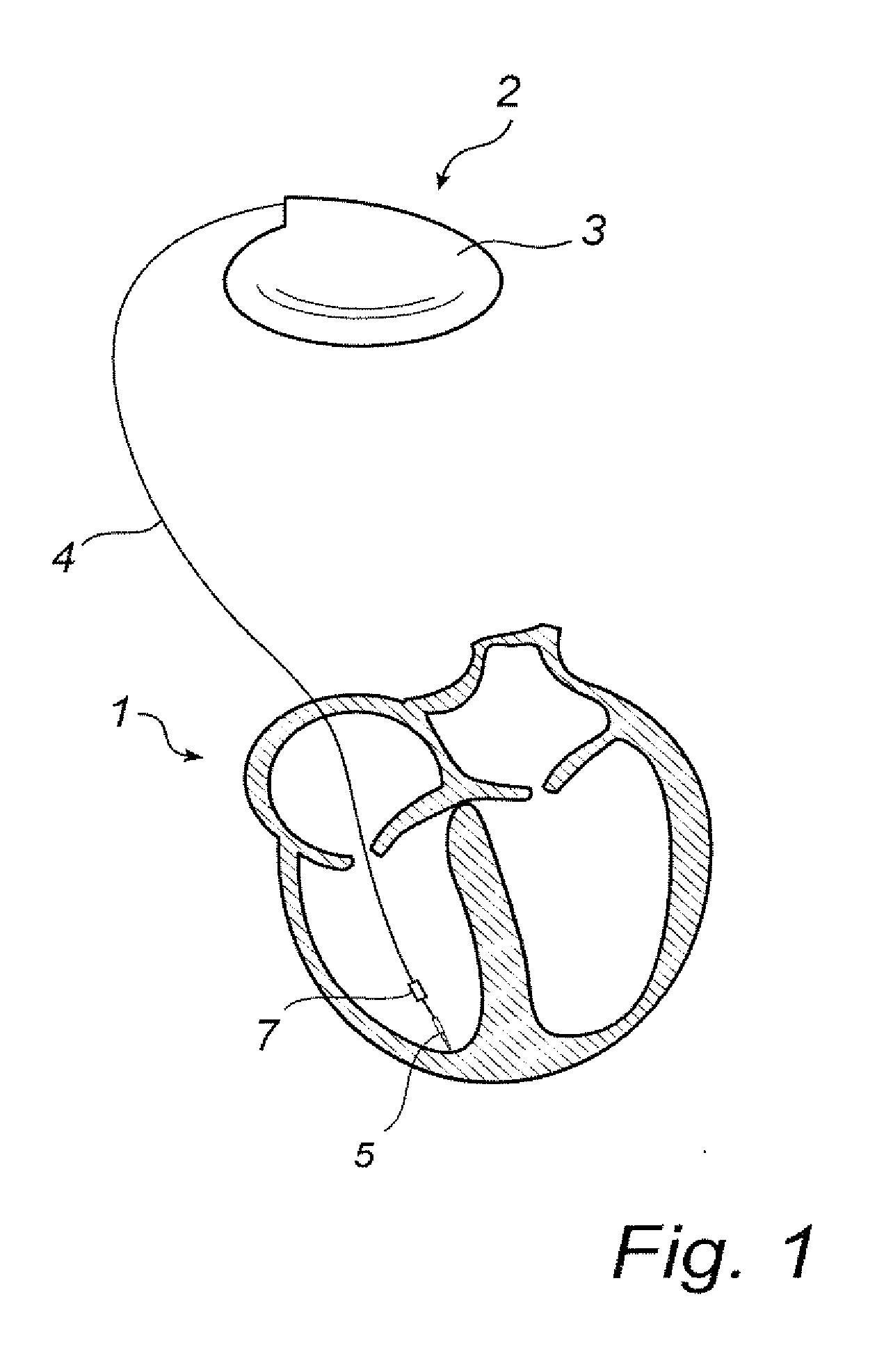 Implantable Lead with a Stimulating Electrode and a Mapping Electrode that is Electrically Disconnectable
