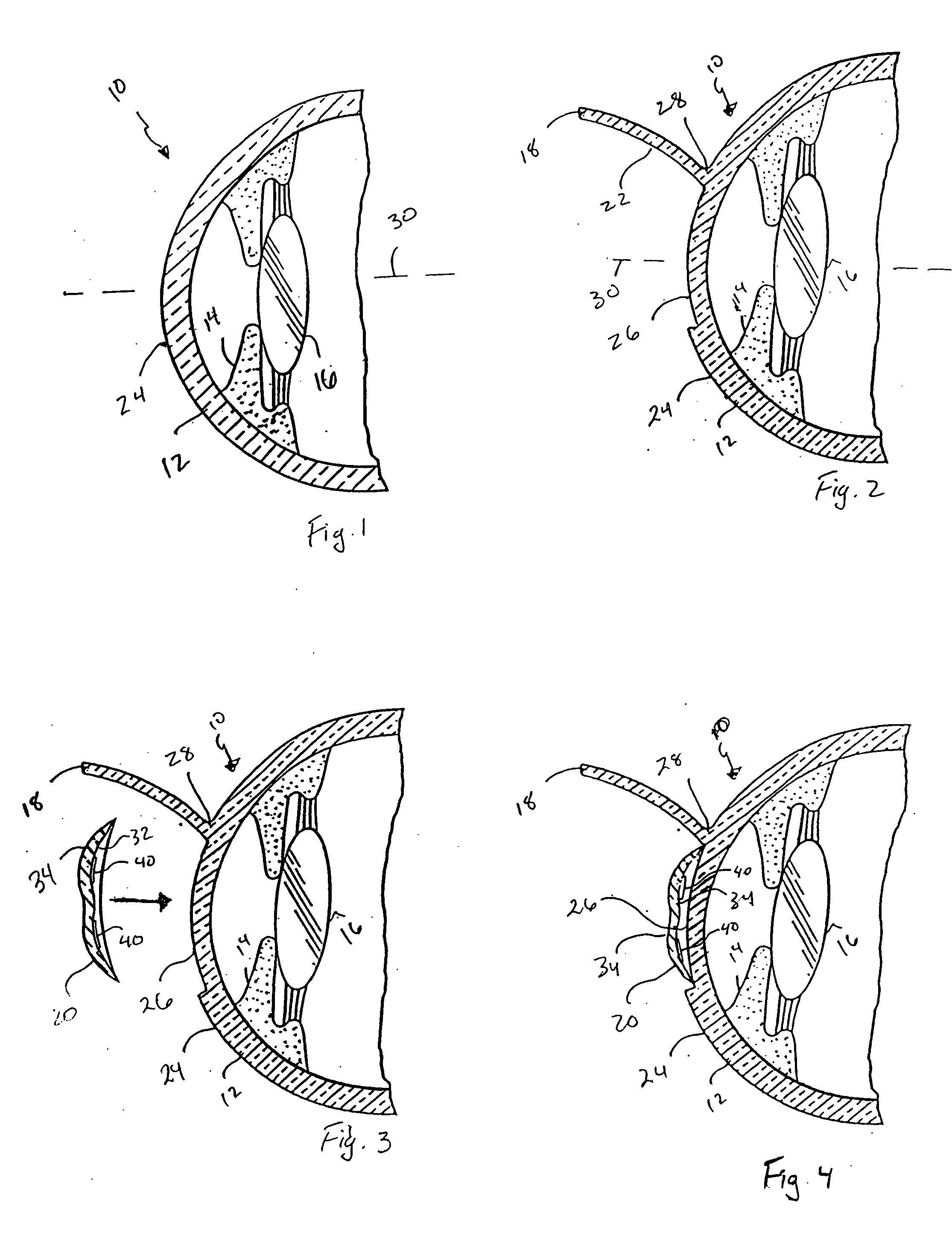 Method and apparatus for reshaping the cornea by controlled thermal delivery