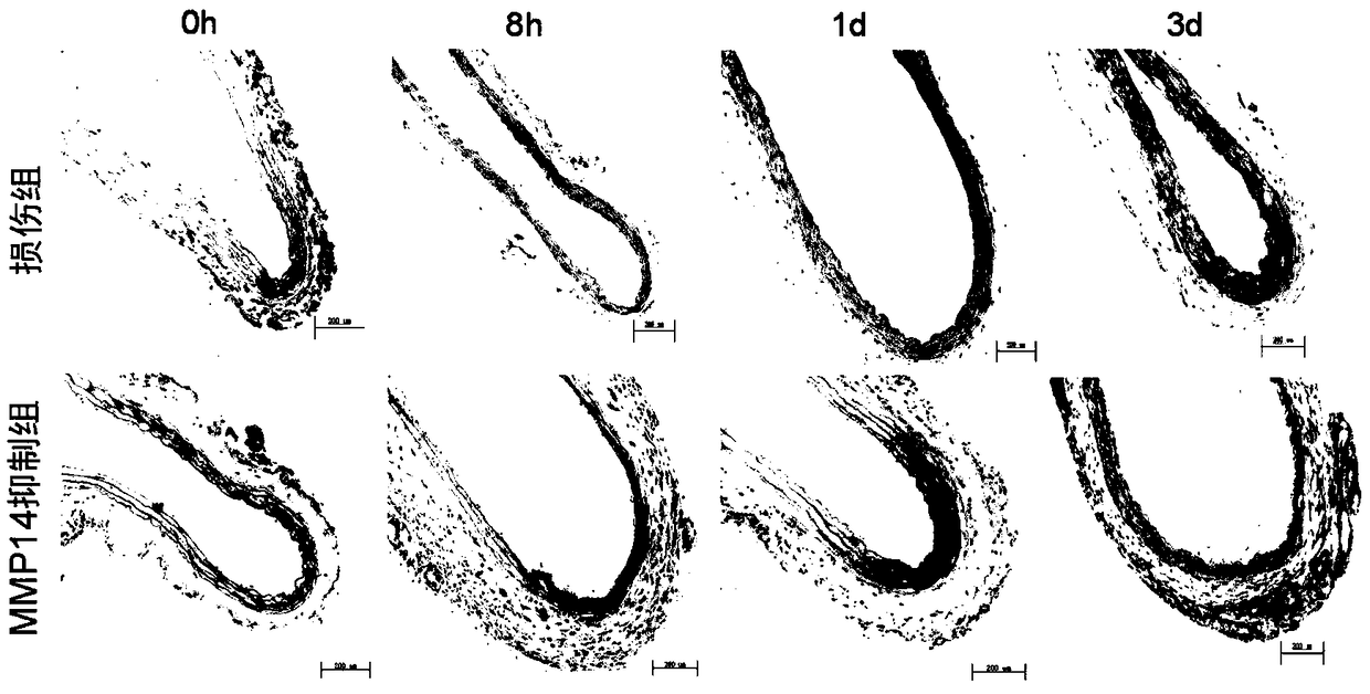 Application of MMP-14 inhibitor in preparation of medicines for treating blood vessel injury