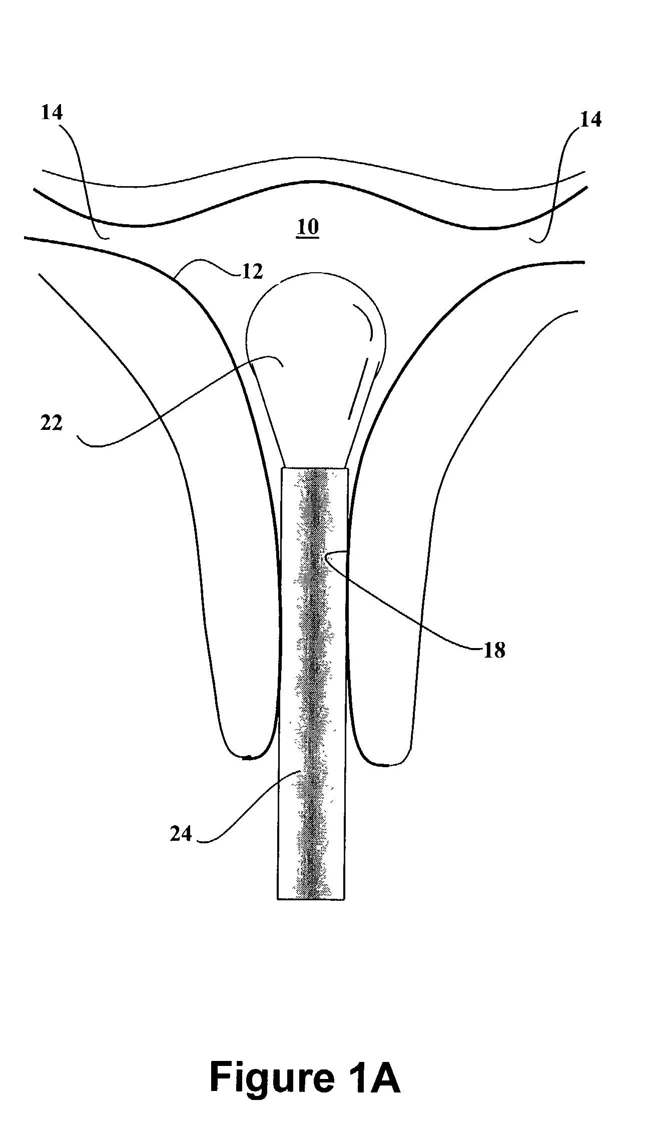 Dip-molded polymeric medical devices with reverse thickness gradient, and method of making same