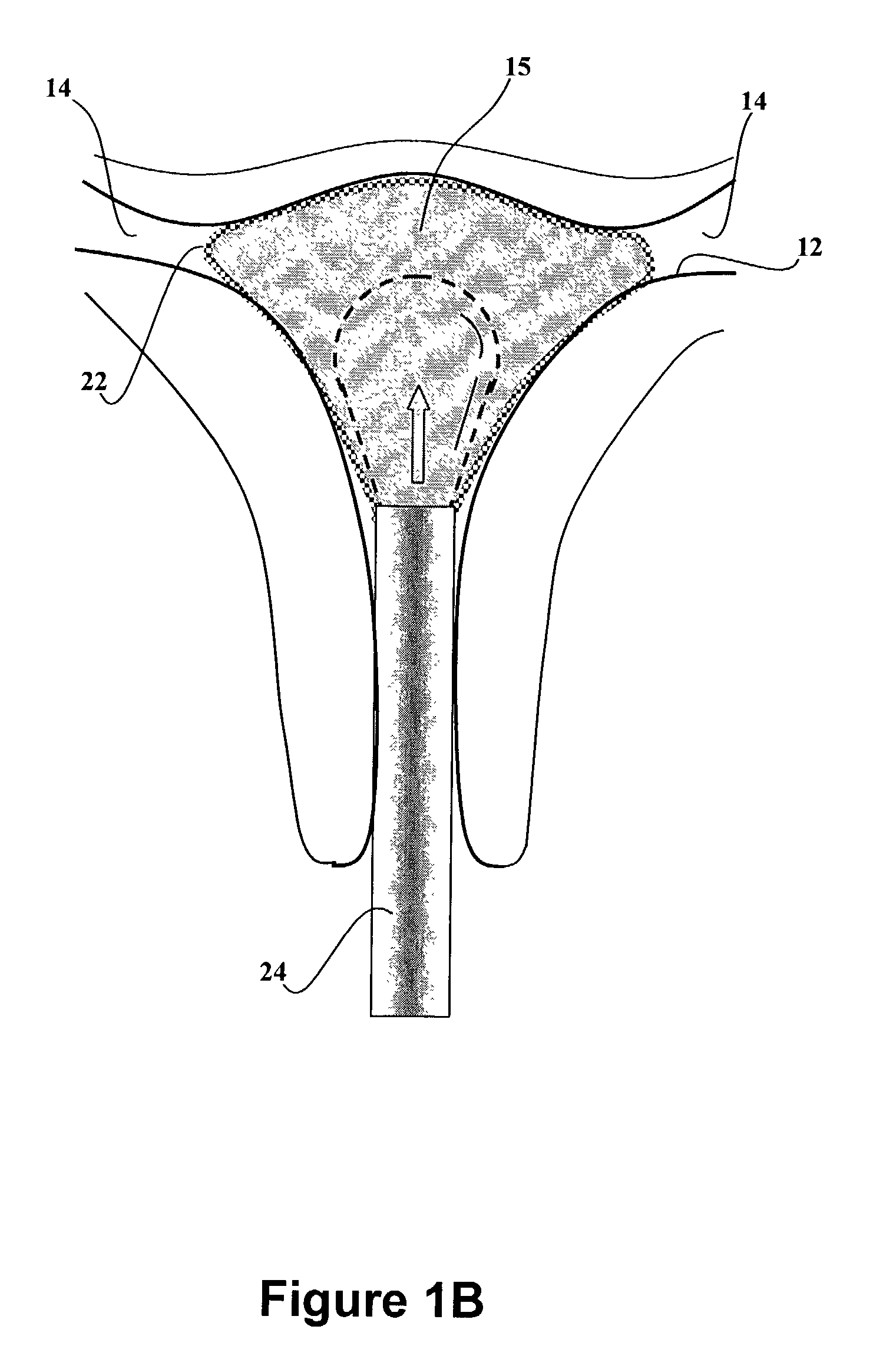 Dip-molded polymeric medical devices with reverse thickness gradient, and method of making same