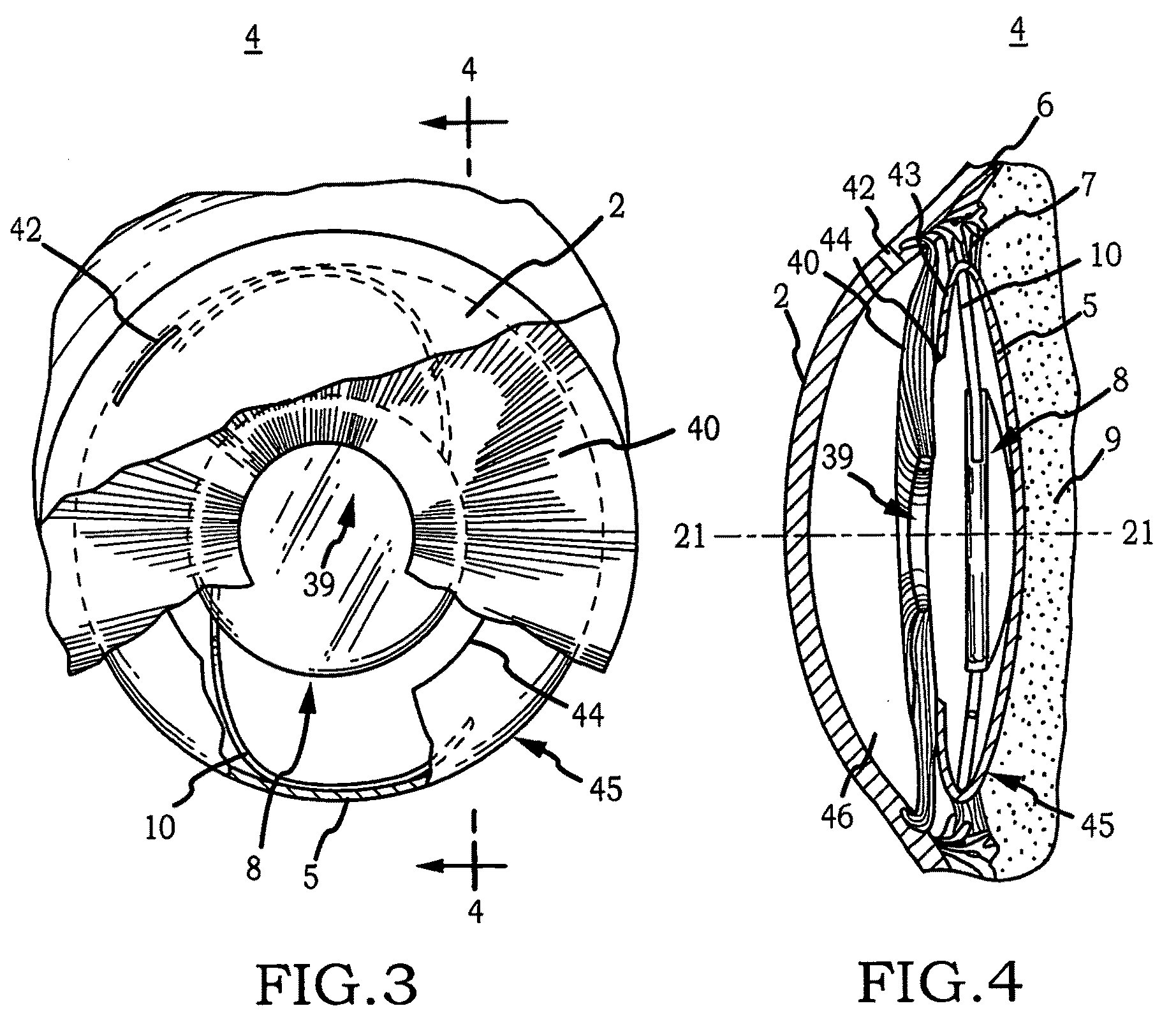 Intraocular implant cell migration inhibition system