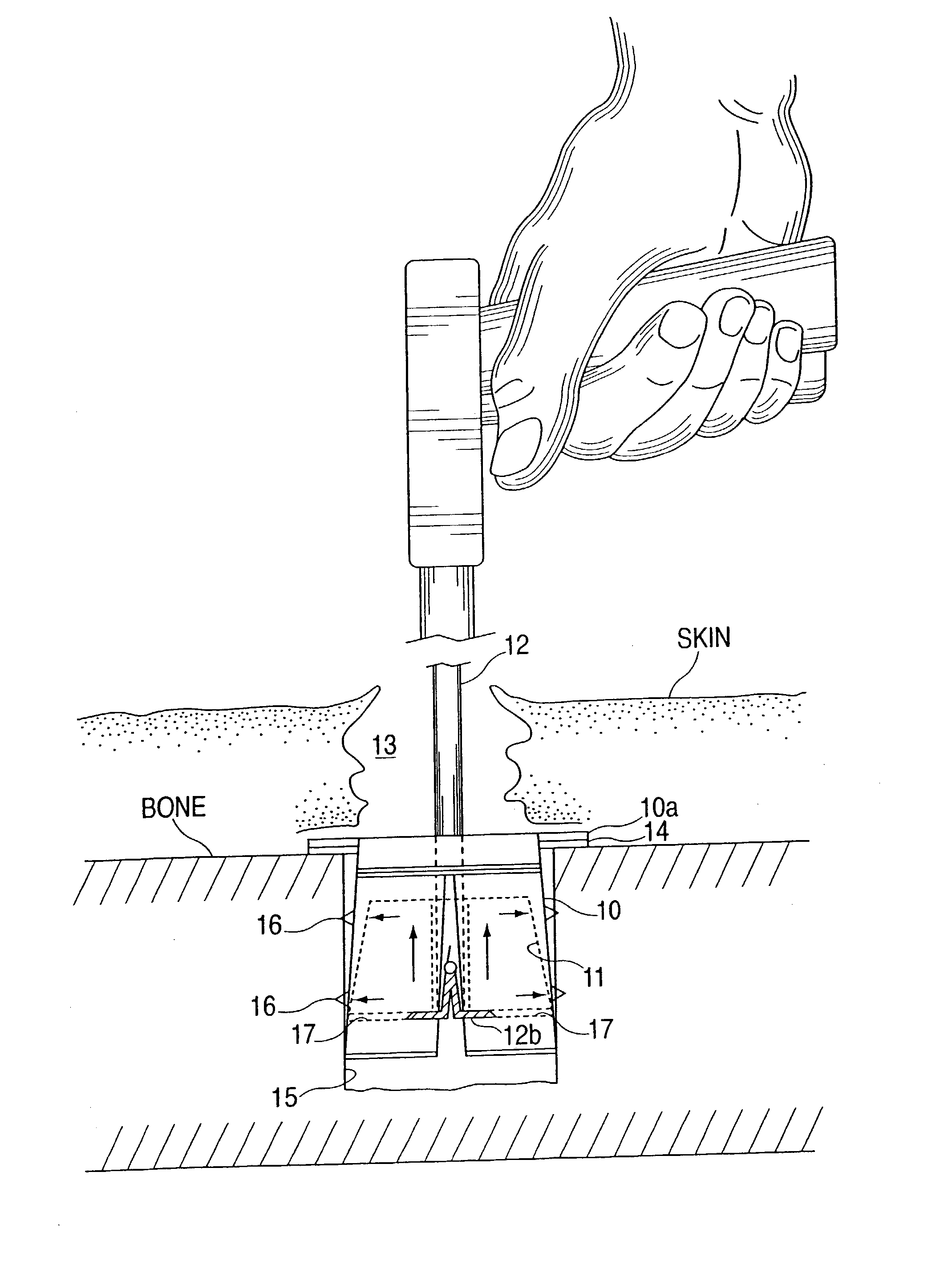 Device for installing an anchor in a bone