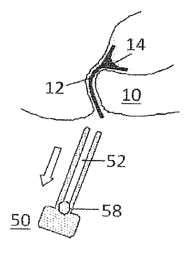 Fecal incontinence device, systems and method