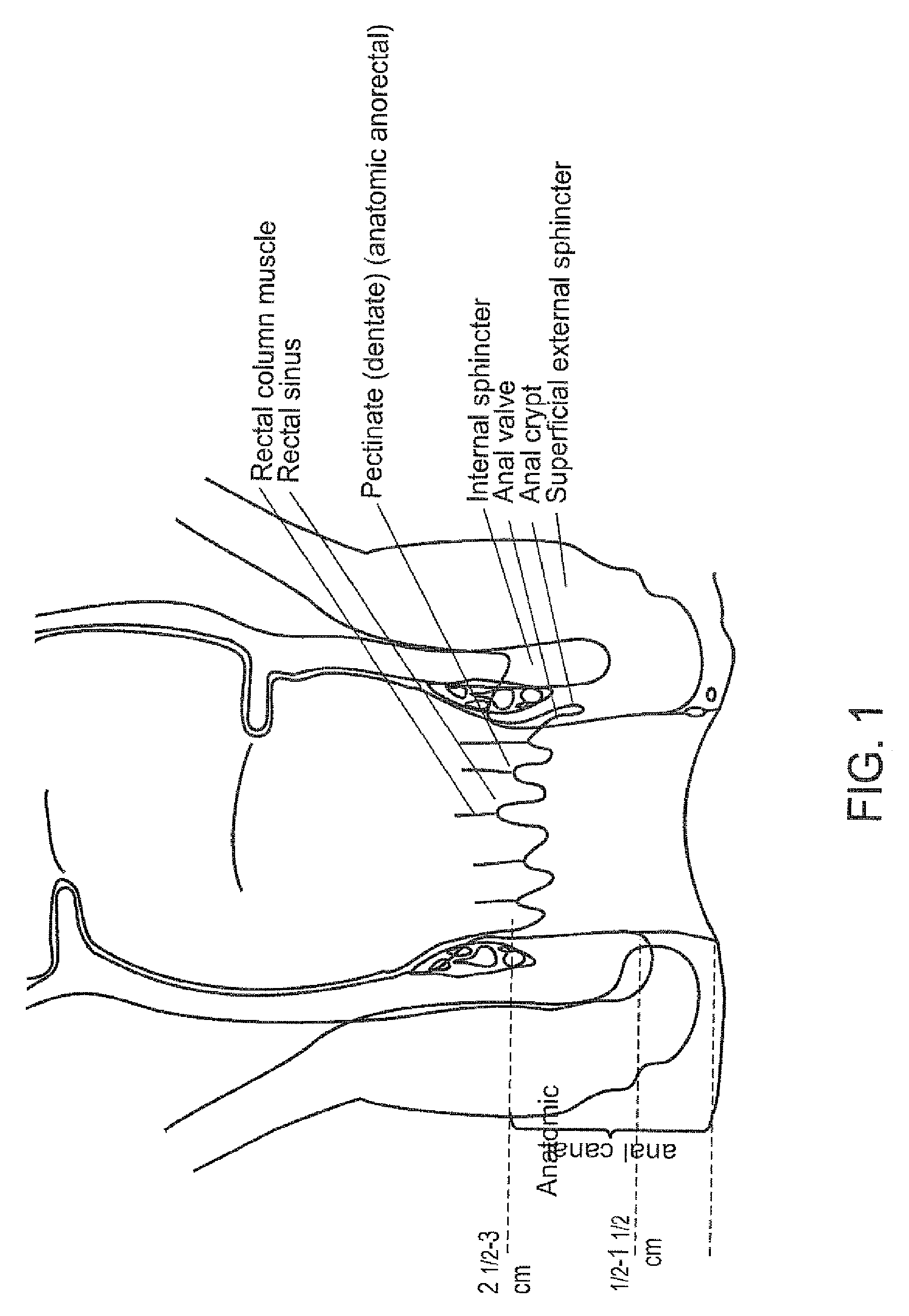 Fecal incontinence device, systems and method