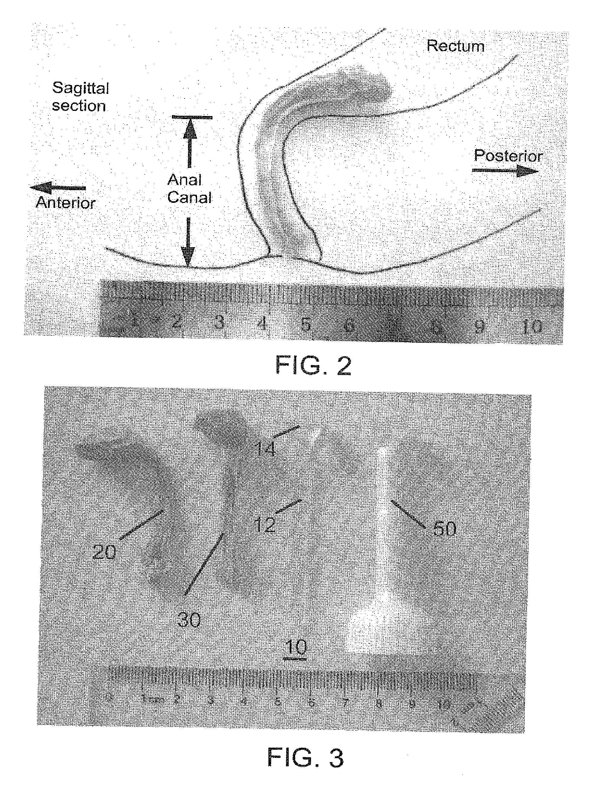 Fecal incontinence device, systems and method