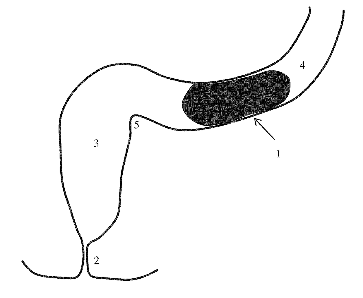 Devices for testing distal colonic and anorectal function