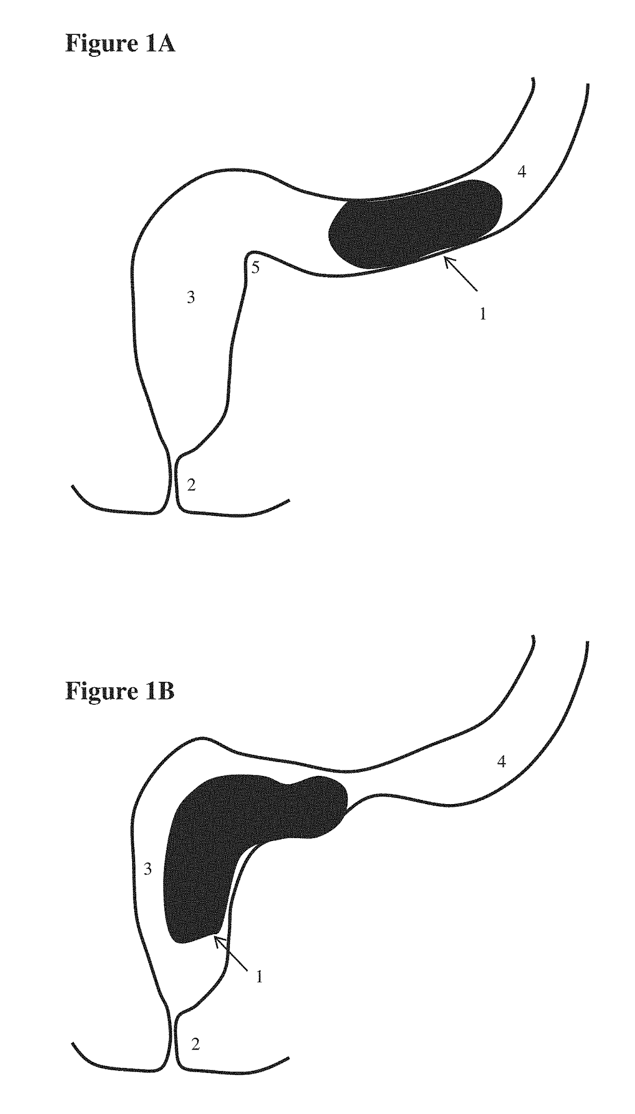 Devices for testing distal colonic and anorectal function