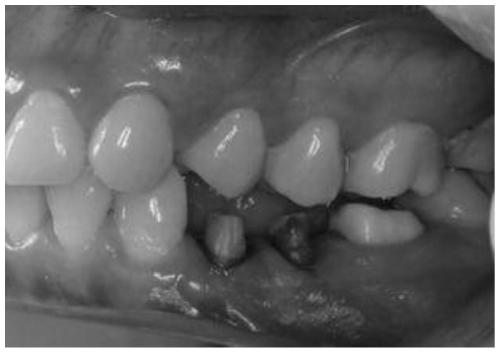 Dental Restoration Procurement Method and Denture Bracket