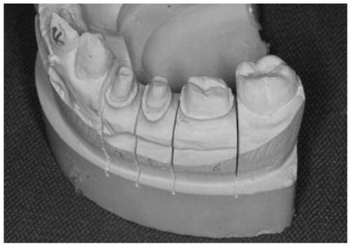 Dental Restoration Procurement Method and Denture Bracket