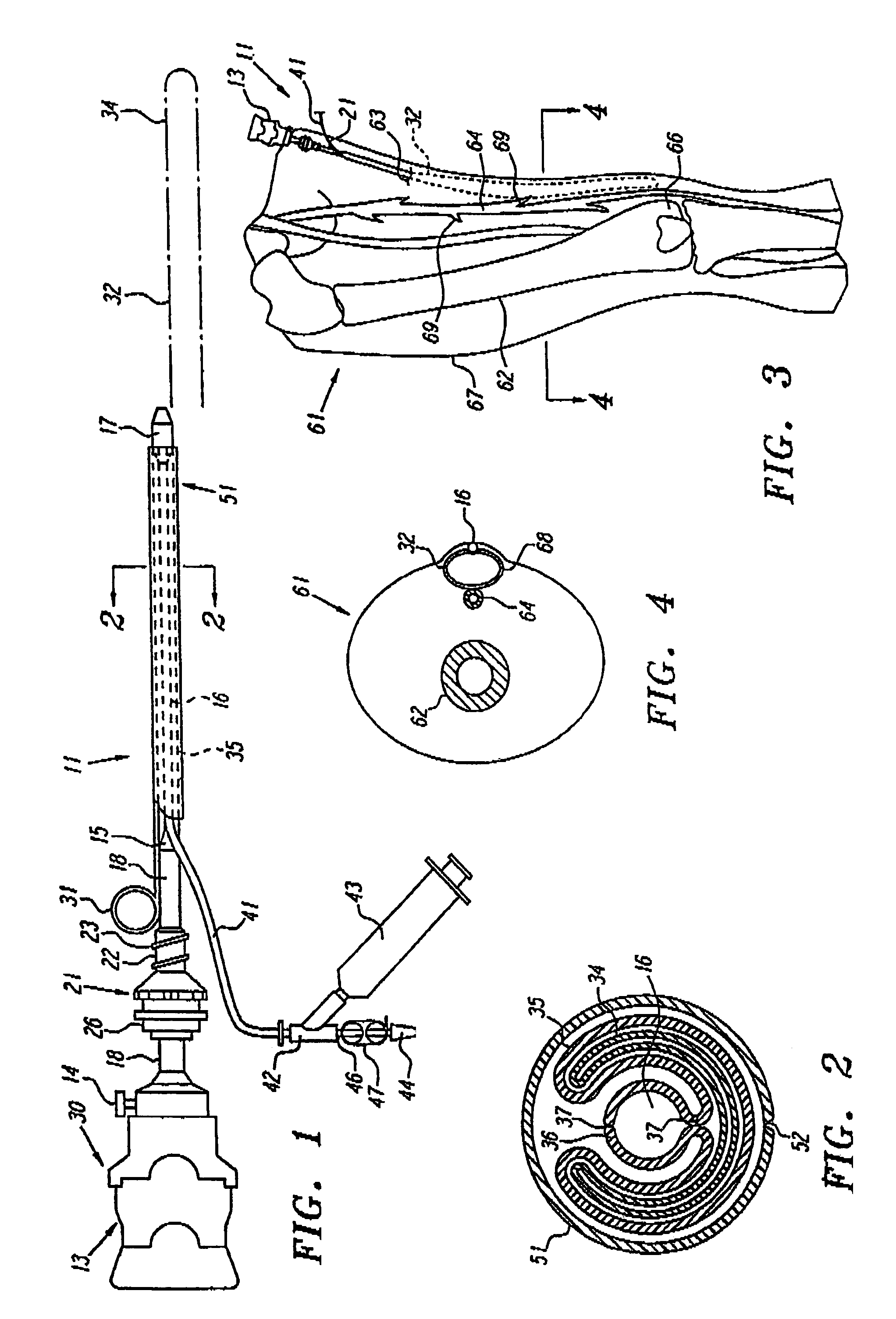 Extraluminal balloon dissection