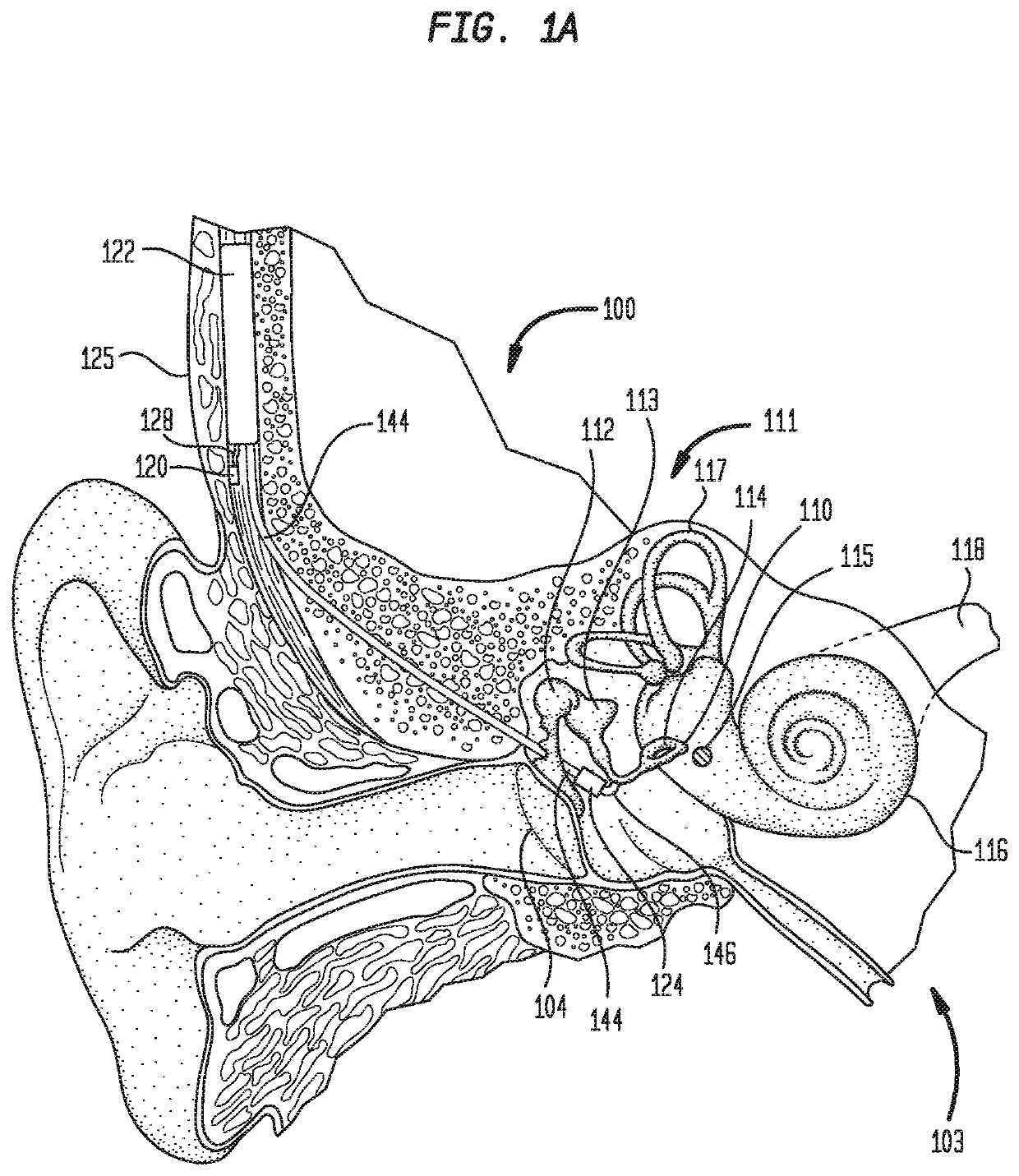 Intra-operative determination of vibratory coupling efficiency