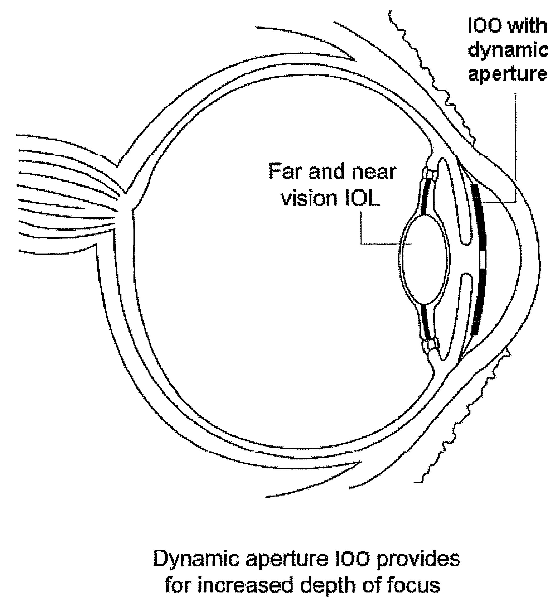 Ophthalmic dynamic aperture
